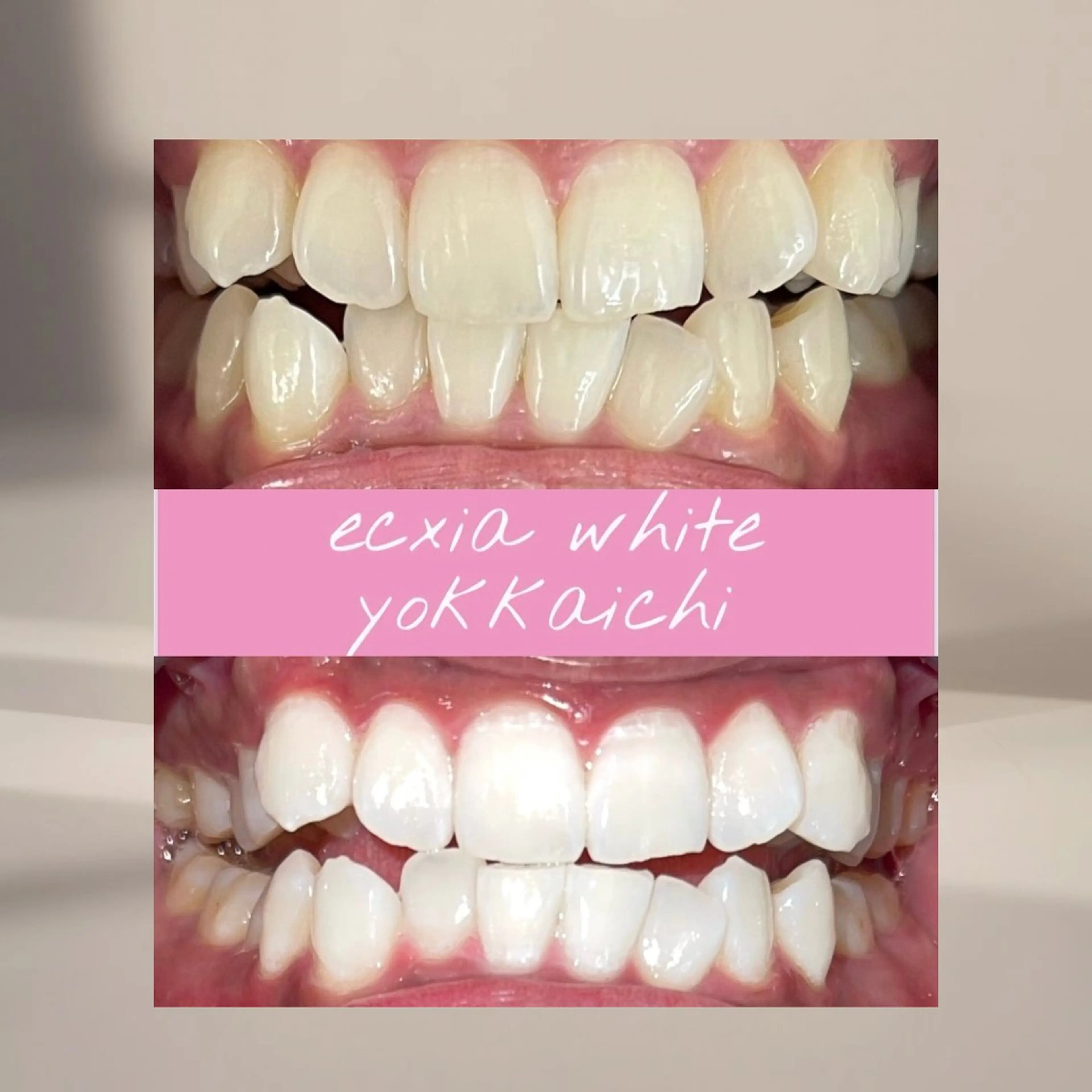 【定額通い放題プラン】セルフホワイトニング１ヶ月￥11000の写真