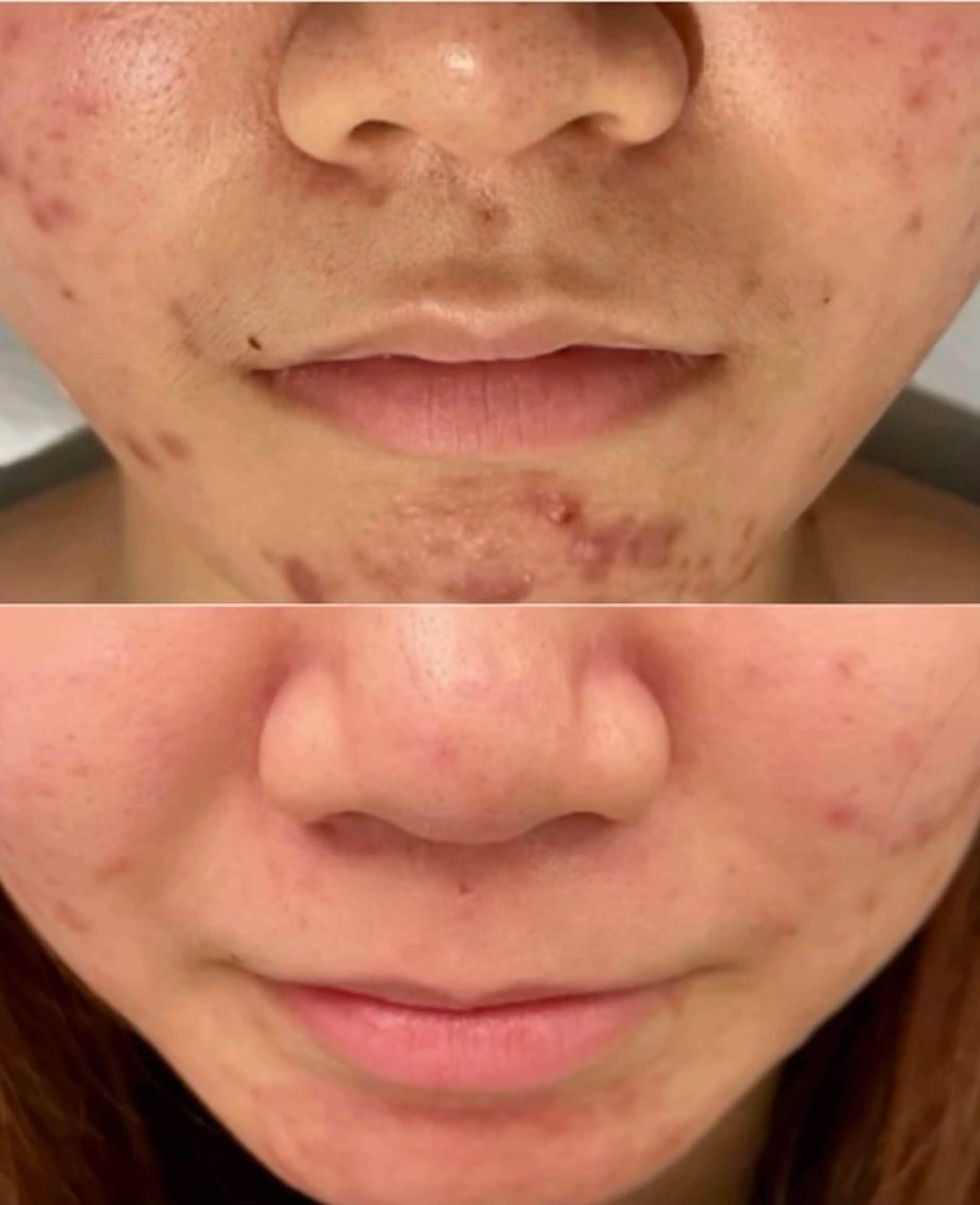 【最新機種アクアダーマ✖️ニキビ】頑固なニキビ肌ケアに✨の写真