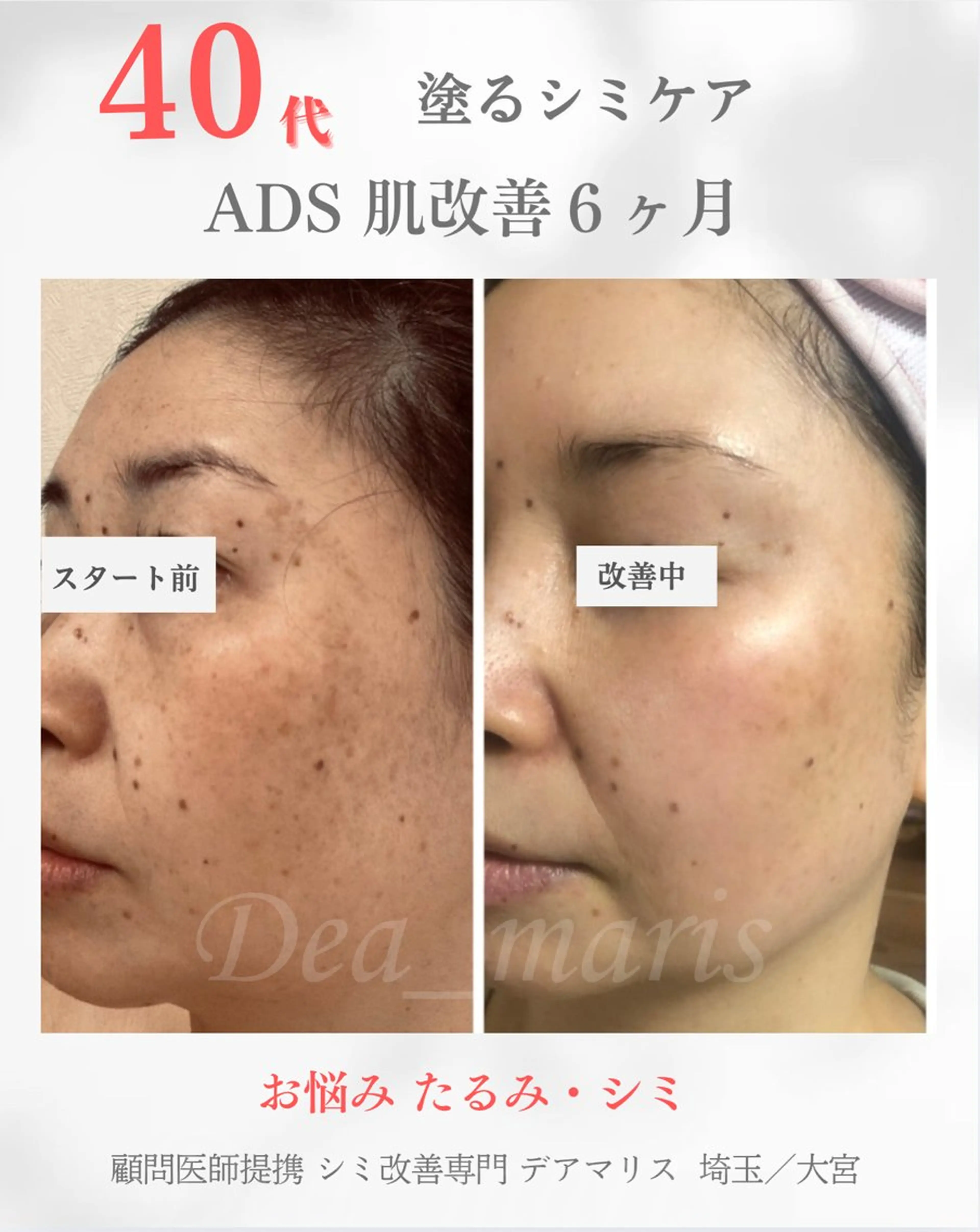 private salon  Dea_maris シュガーリング＆パーソナルボディケア所属・シミ改善・韓国肌管理 ボディメイク痩身のその他イメージ