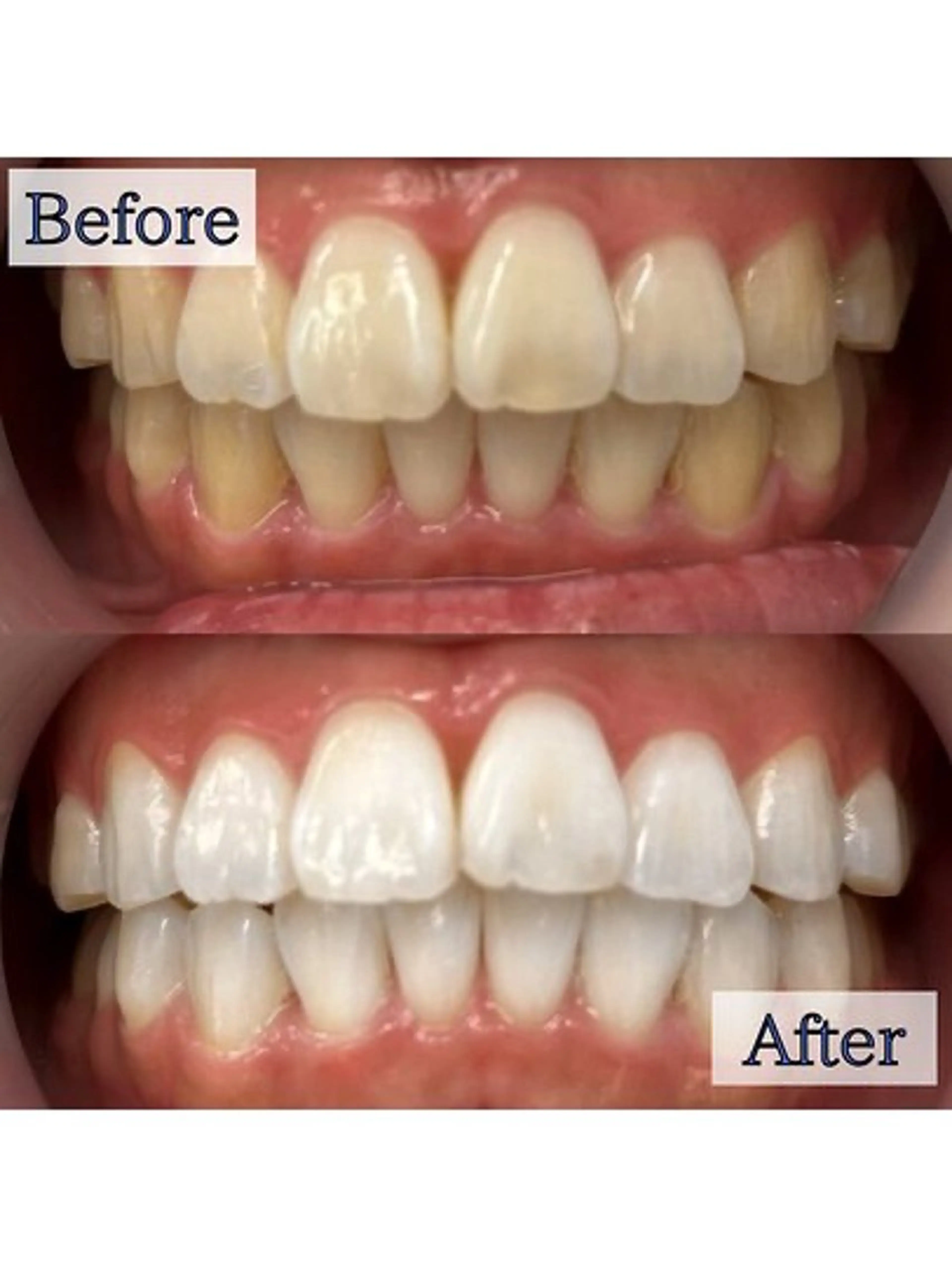 【💛早さ×効果に自信あり💛】5分照射×4回🦷通常の約2倍の照射パワーで即効性⭕️ハイパワーセルフホワイトニング🔥の写真