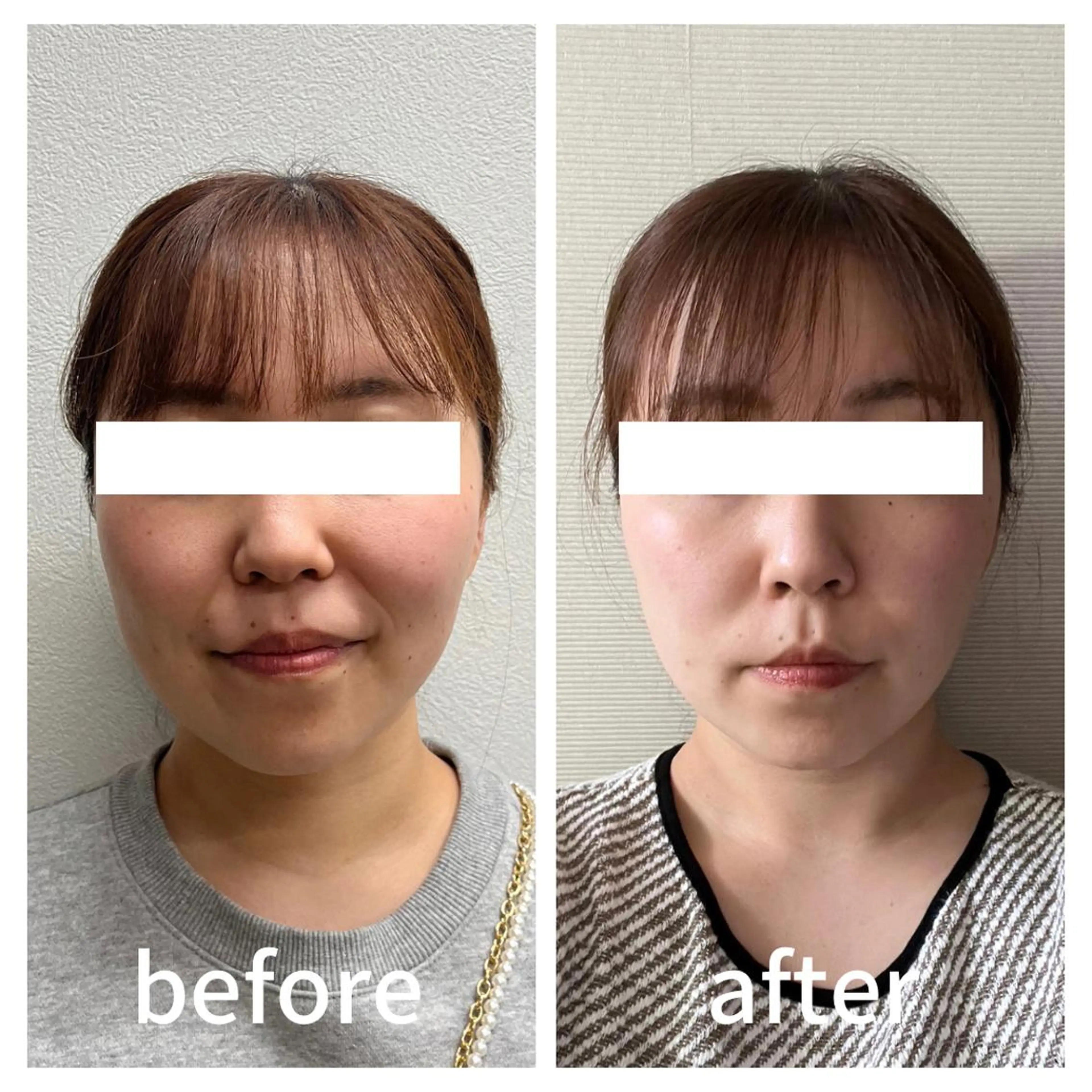 5名様限定🉐痛くない小顔矯正コースの写真