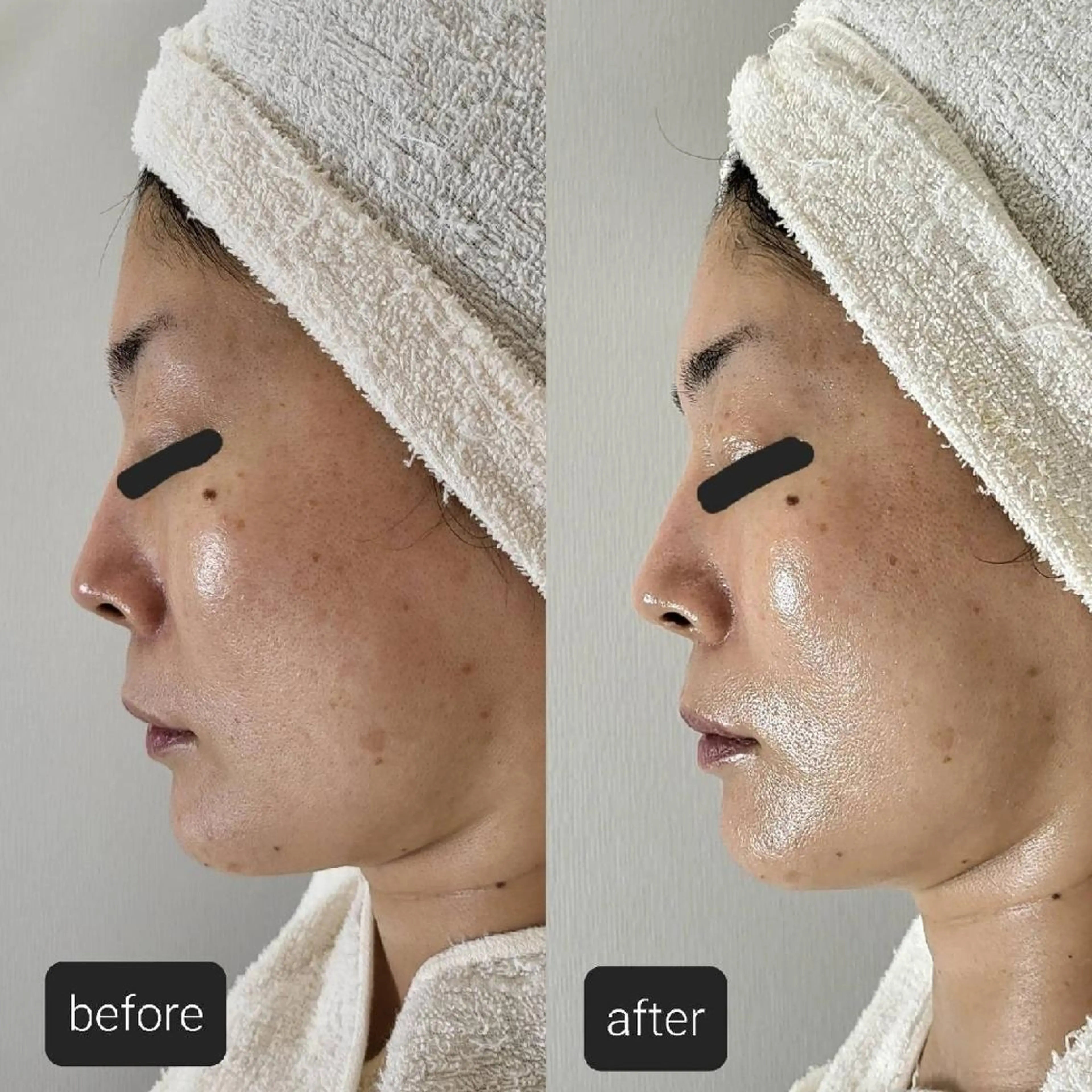 ニキビケア◇ニキビ跡 レゾン京橋店　峠山のエステ・リラクイメージ