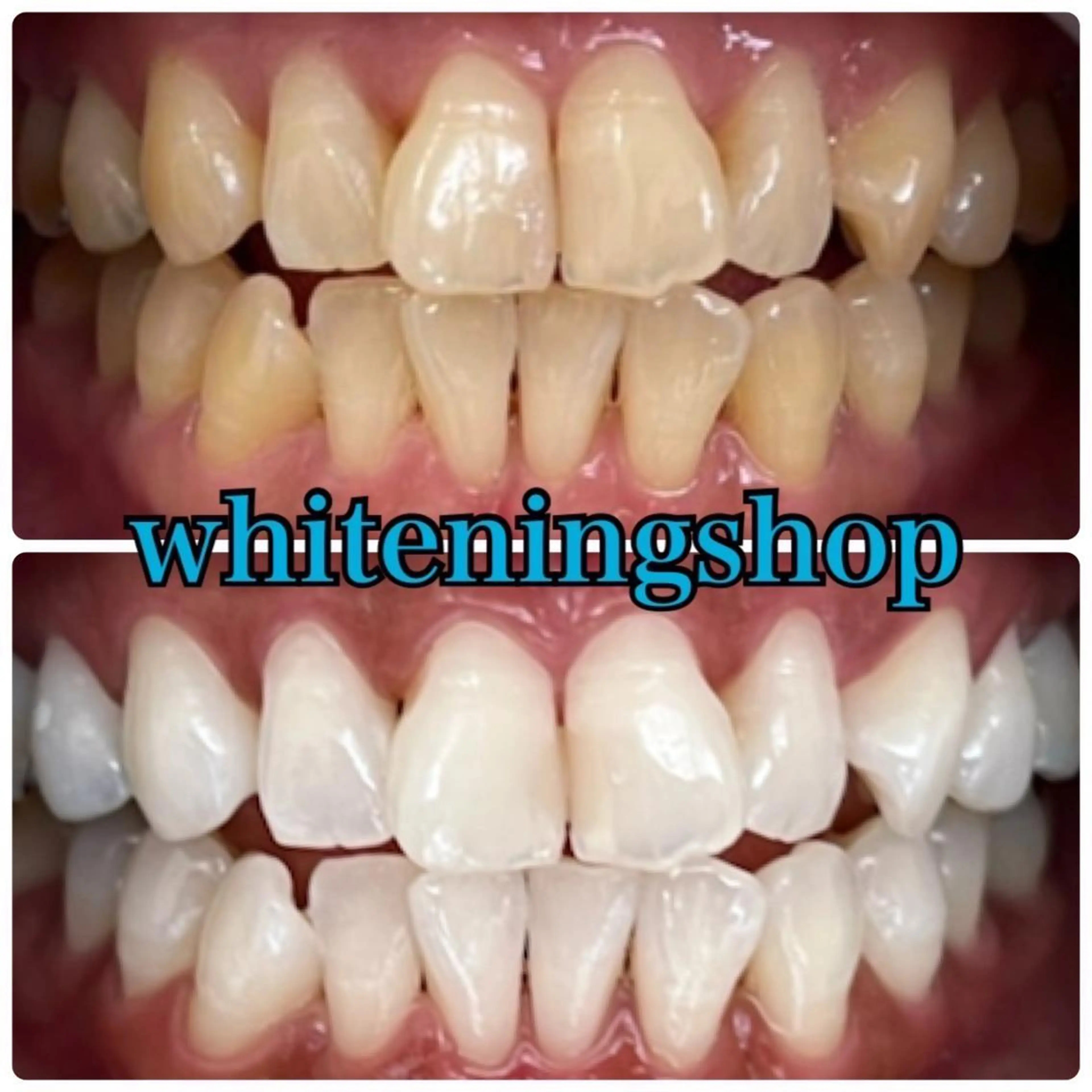 【🌟チラシお持ちの方限定】チラシをお持ちの方はこちらから◎/ホワイトニングの写真