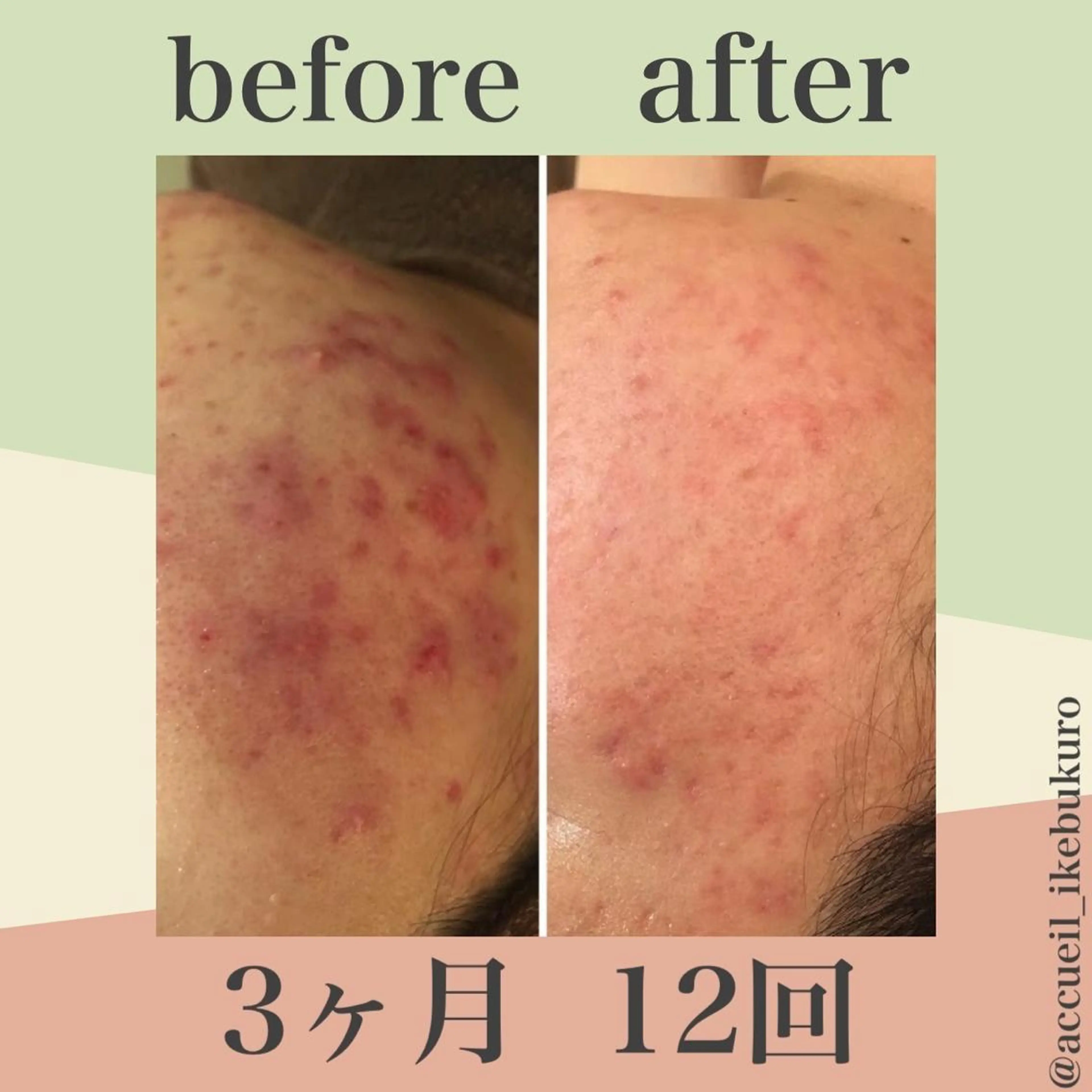 ミディアム カラー パーマ ヘアアレンジ メンズ キッズ ネイル マツエク・マツパ エステ リラク ニキビ・肌質改善専門 ♡人生が変わるサロンのエステ・リラクイメージ