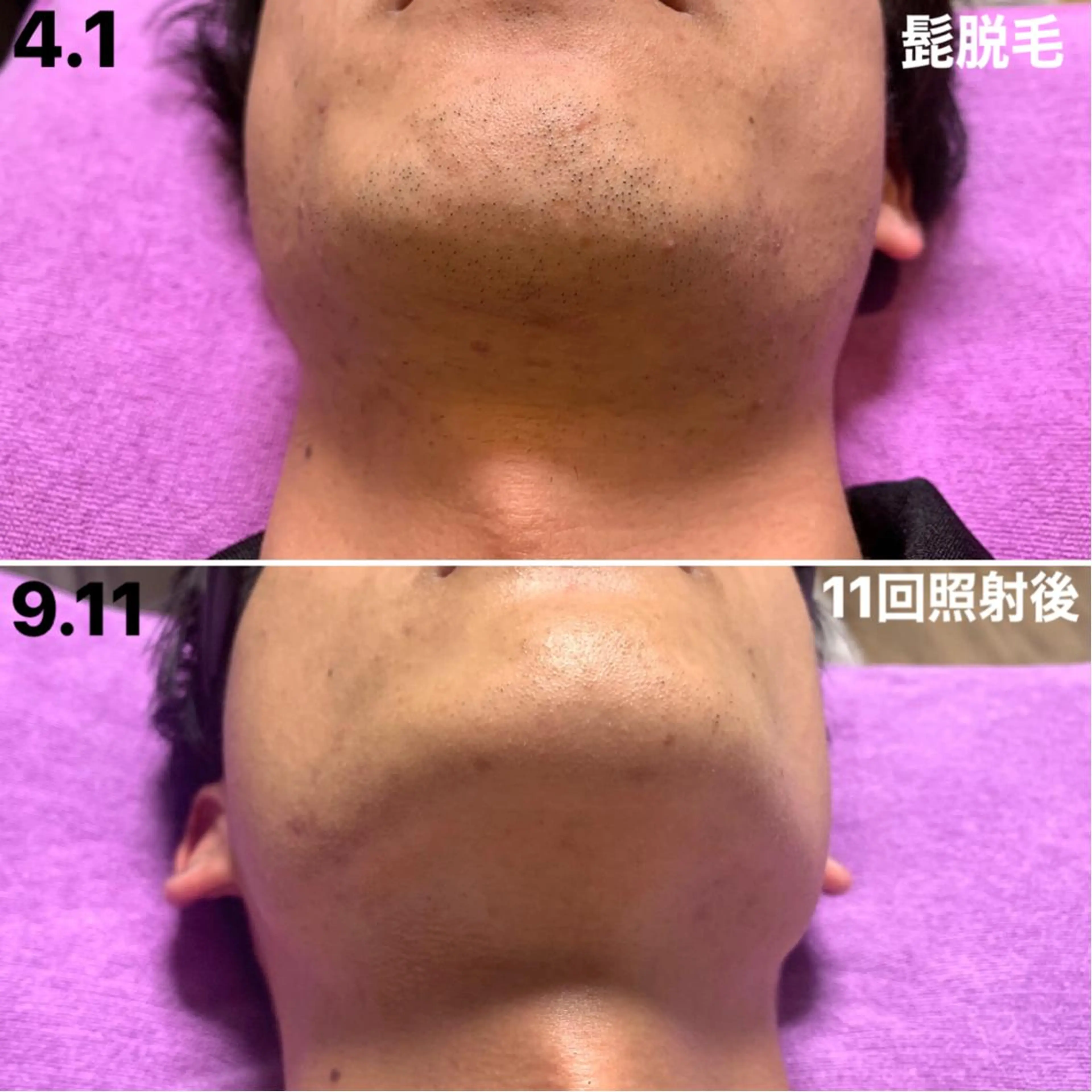 メンズ 脱毛＆エステサロン【アンリミット】所属・森谷 莉美のエステ・リラクイメージ