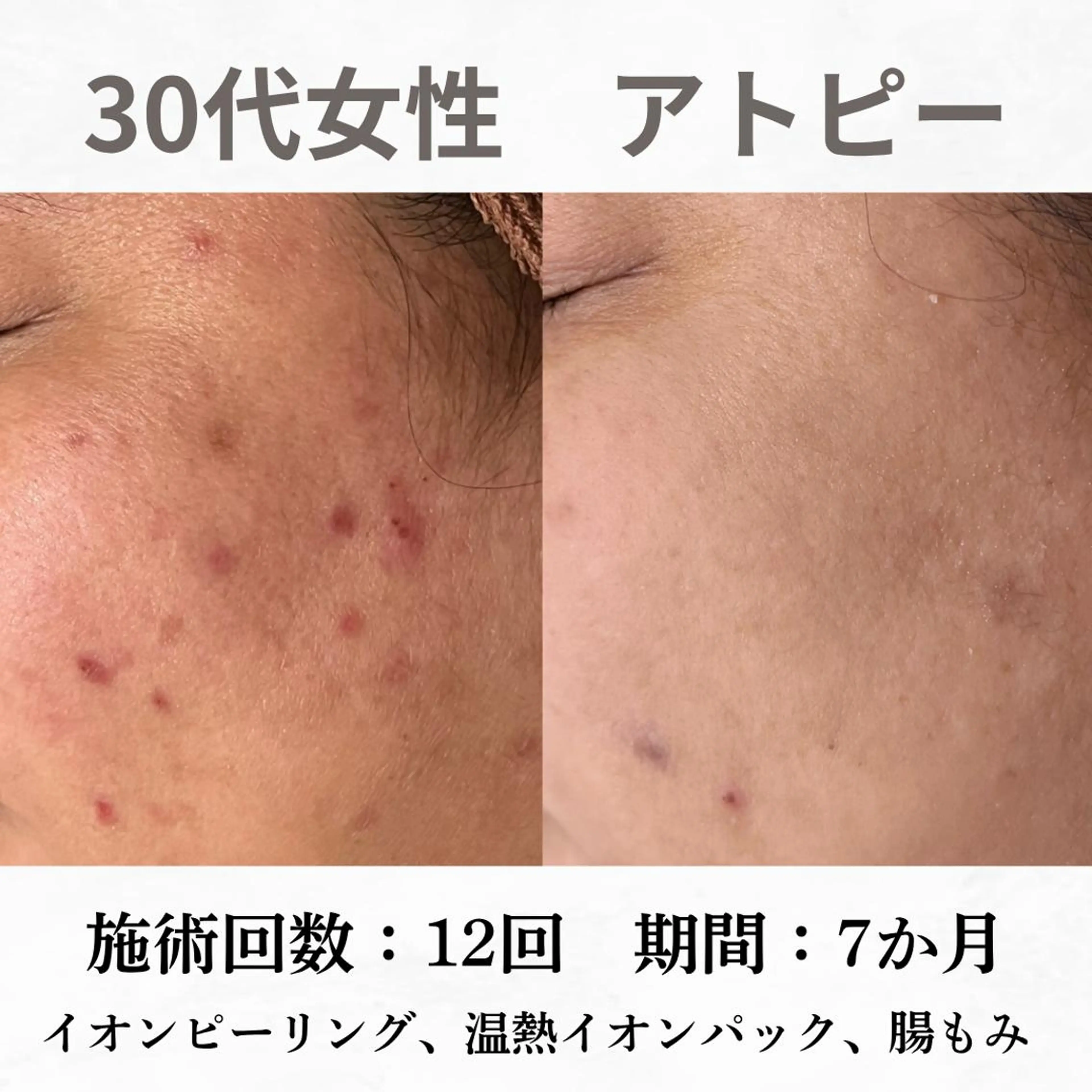 重度ニキビ専門🌷 ダウンタイムなしのエステ・リラクイメージ