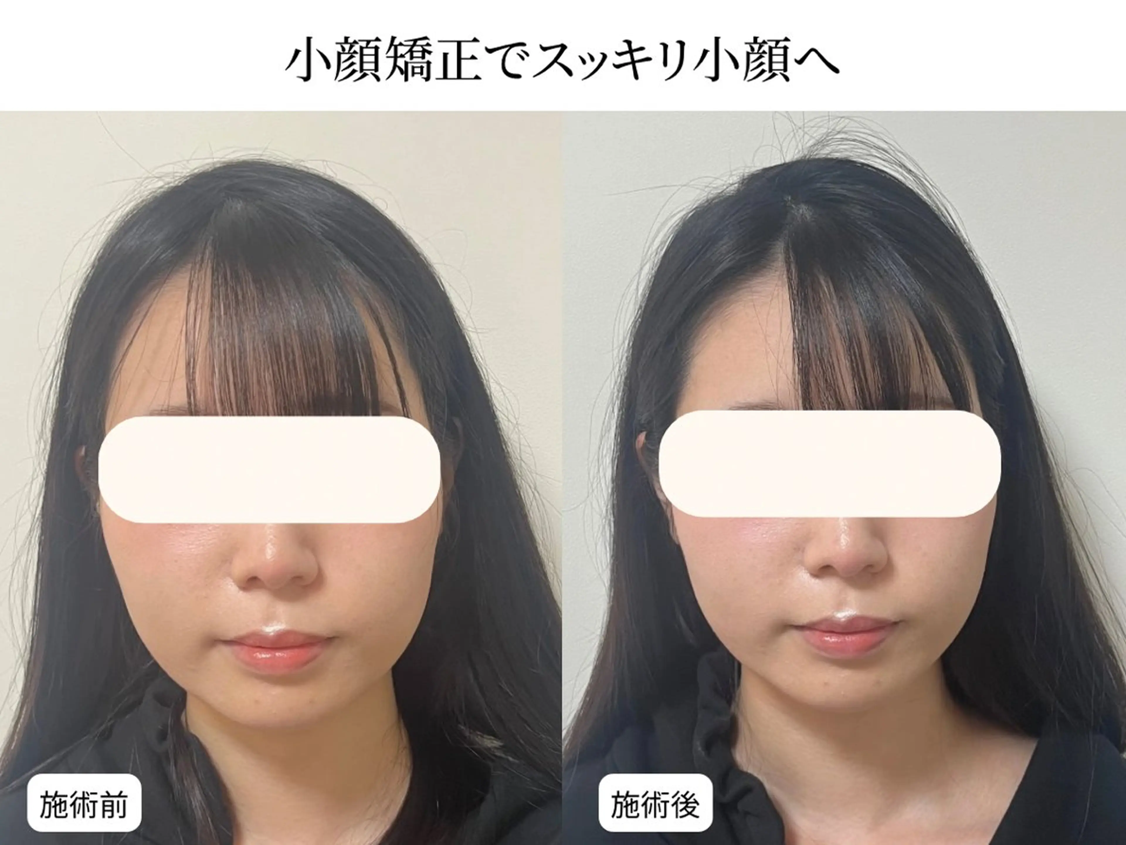 【エラ張り・むくみ改善】小顔整体＋4D小顔矯正＋姿勢矯正　12000円→の写真