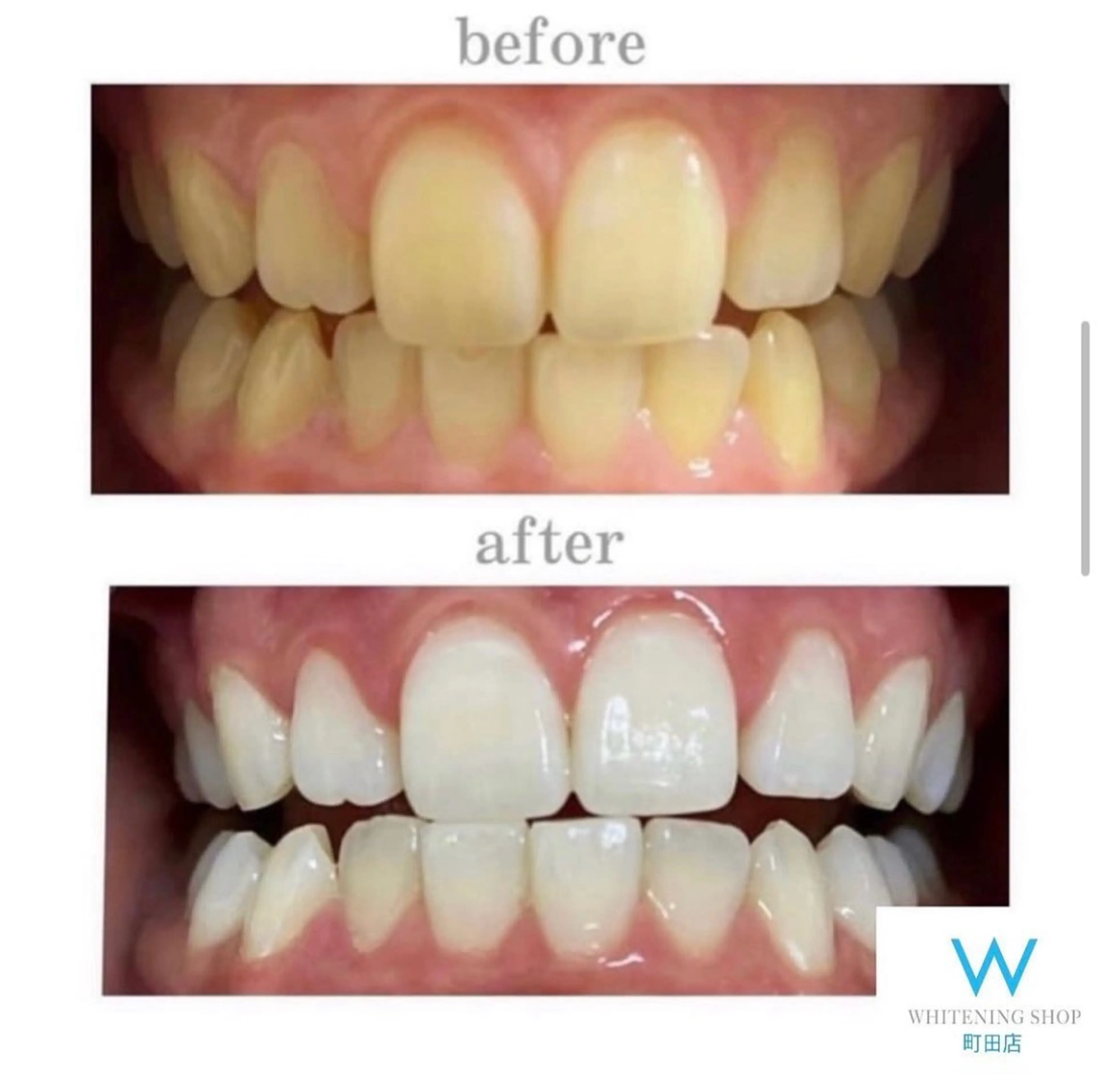 【ミニモ限定】メンズにオススメ🦷セルフホワイトニング1セット(40分)¥6980→¥2500※口コミ条件の写真