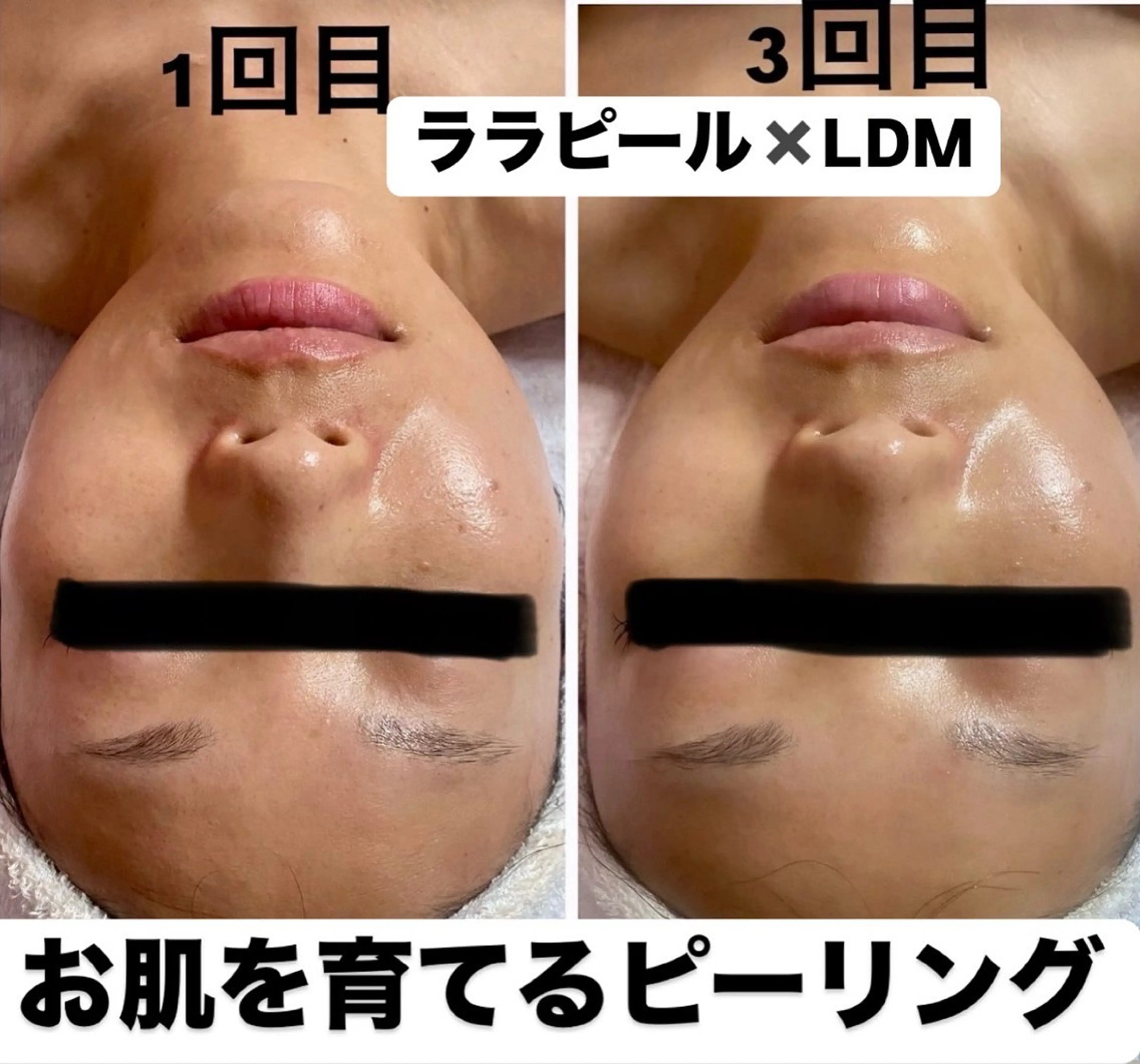 【艶肌＆リフトUP✨】ララピール《顔＋首》＋デコルテリンパ＋LDM導入＋ララゲルマスク付きの写真