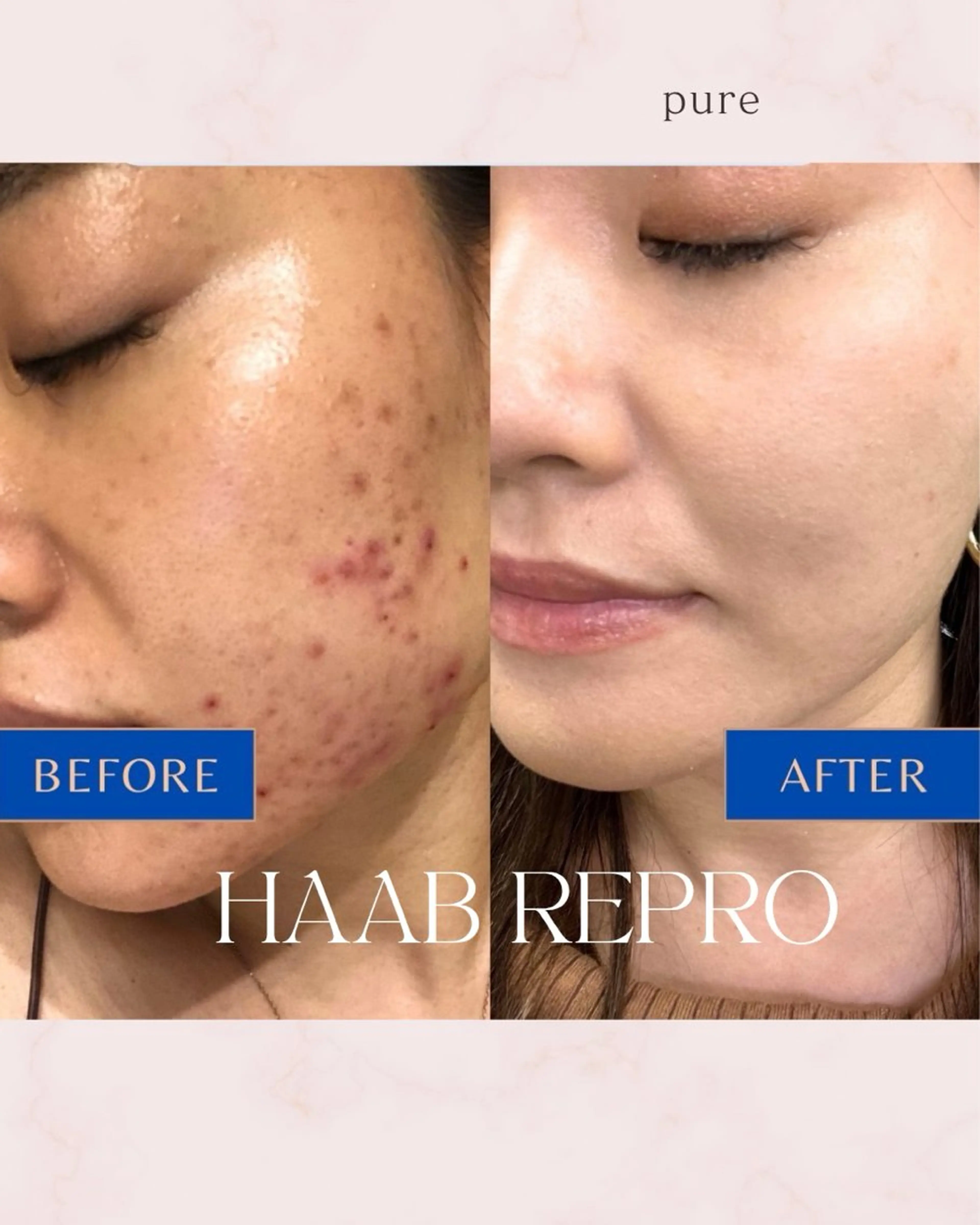 エステ pure所属・肌質改善ピーリング pure 一番町のエステ・リラクイメージ