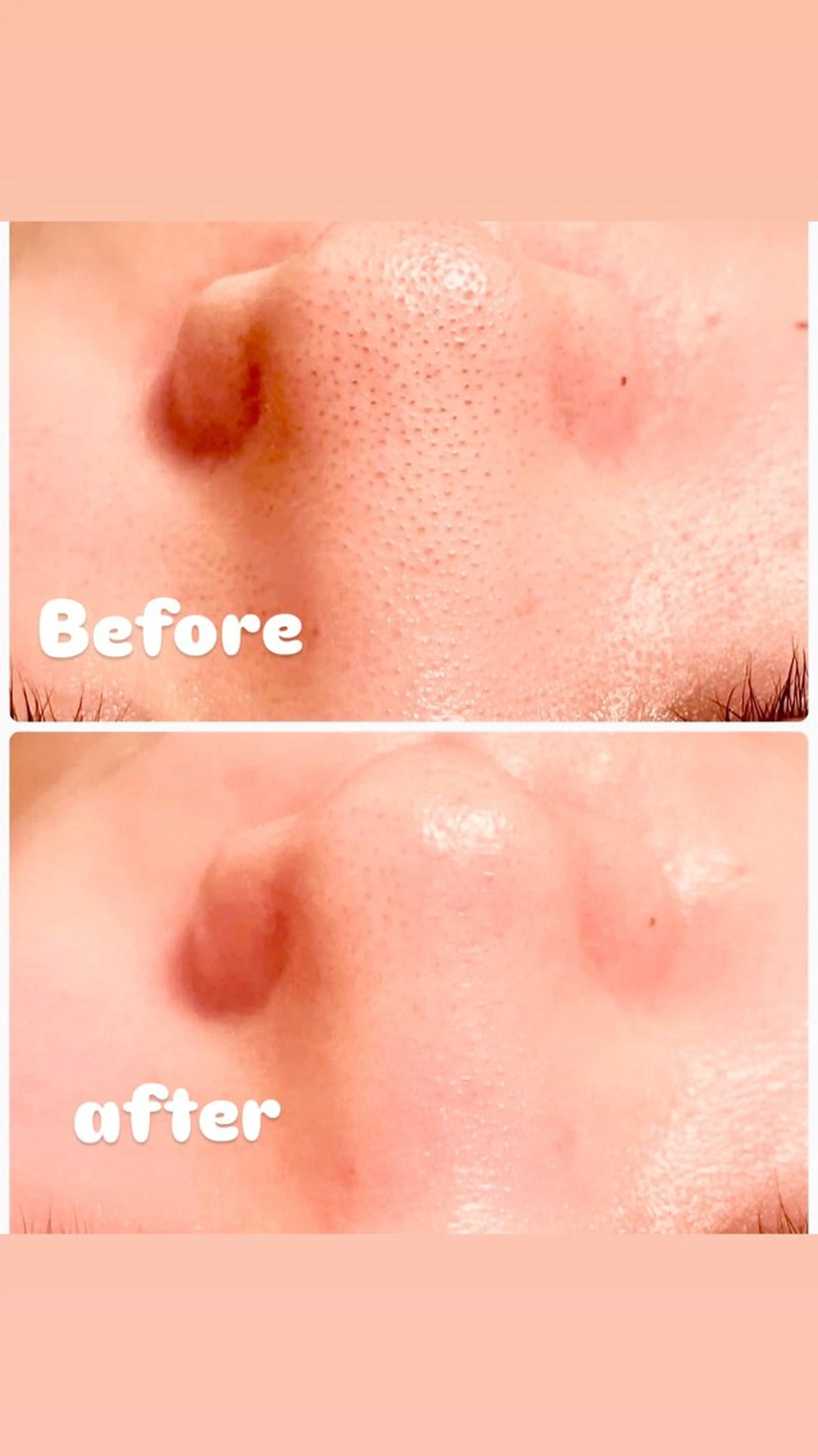 大人気　小鼻ツルツルスペシャルケアの写真