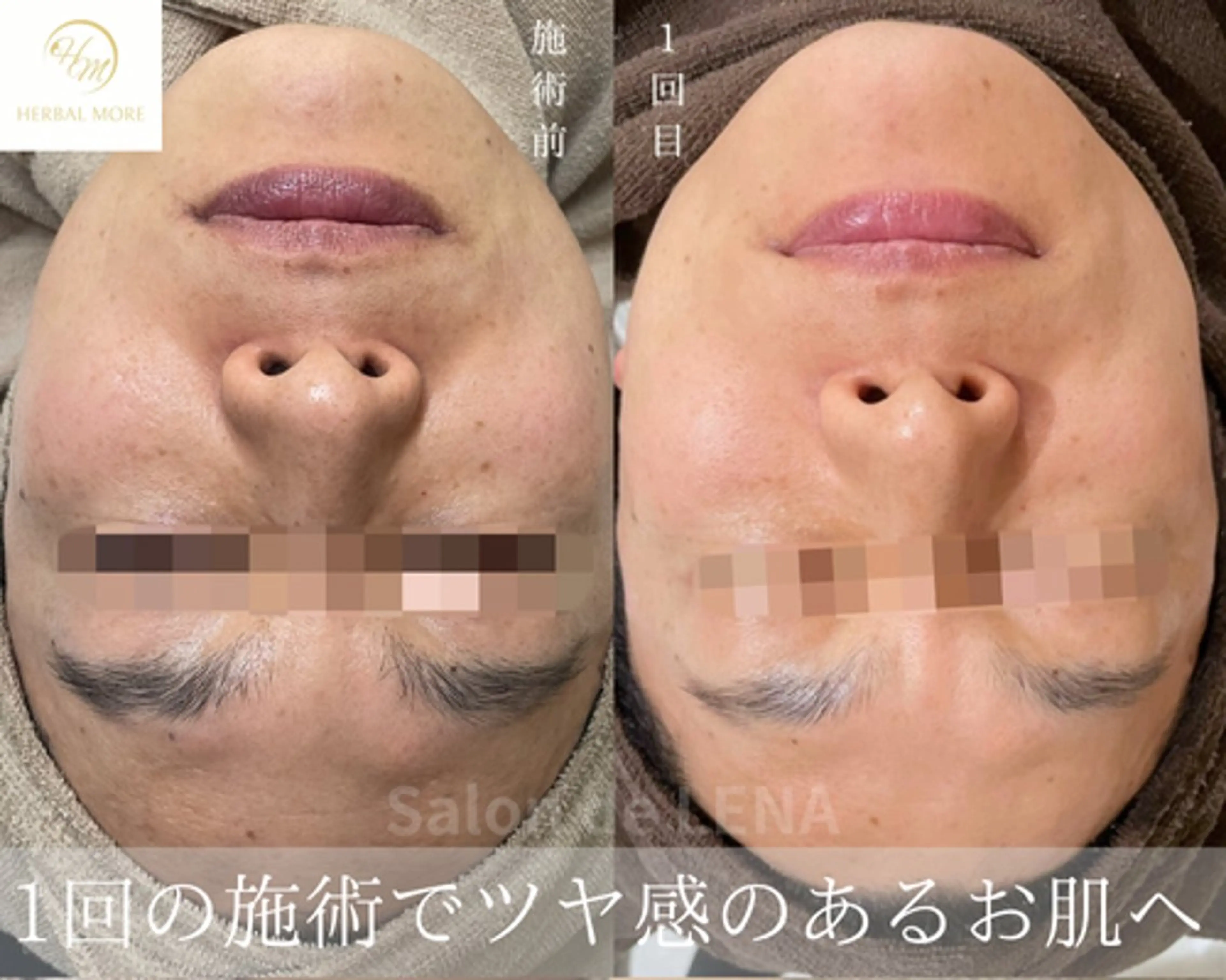 【ワンランク上の毛穴洗浄】1.5倍の洗浄力！毛穴引き締めトリートメント付きの写真