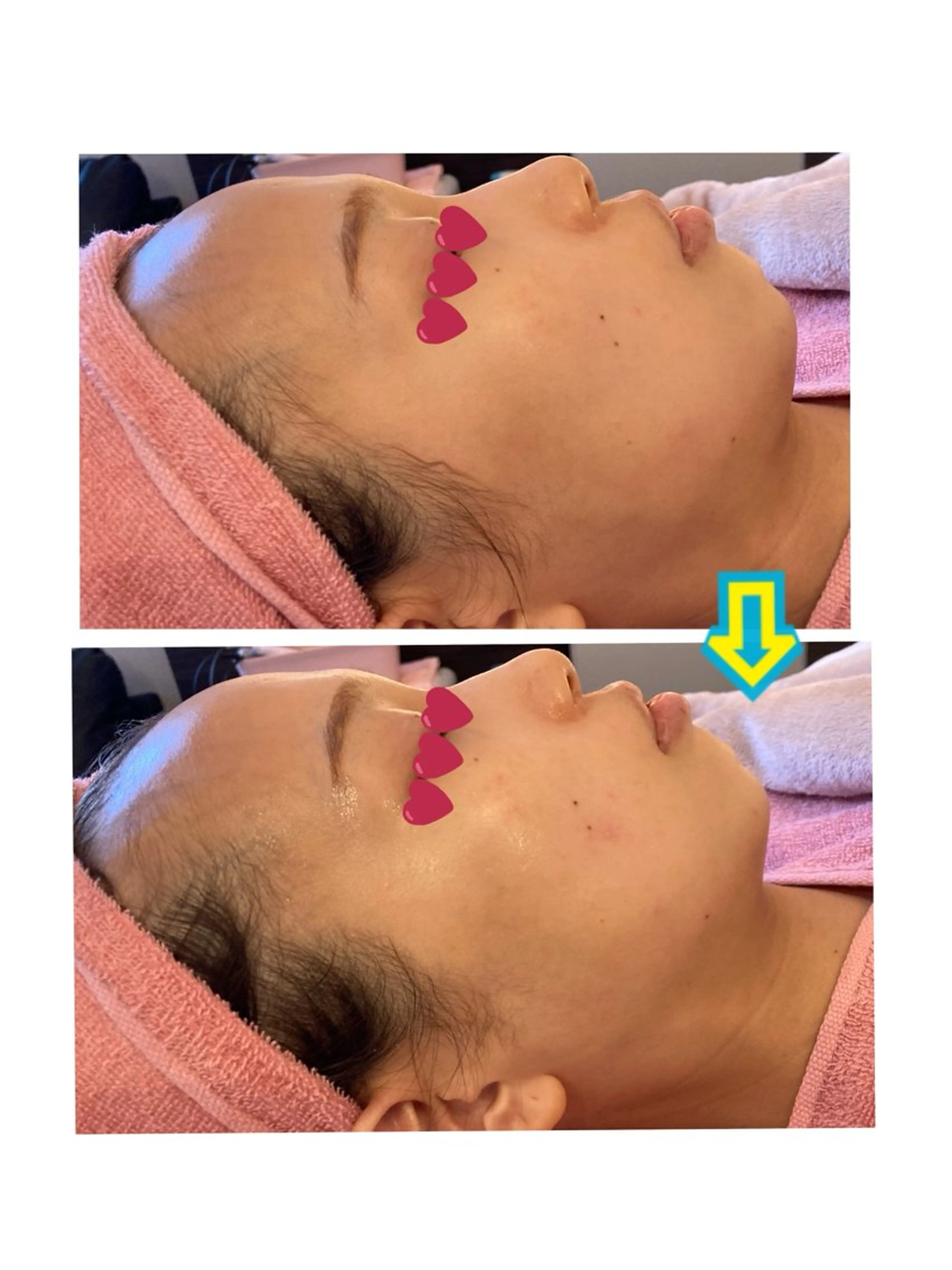 【お試しください初めてご来店の方❣️】大人気の毛穴洗浄＆コラーゲンケアが今だけ🉐お肌の調子が気になる季節にぷる艶肌🥰の写真