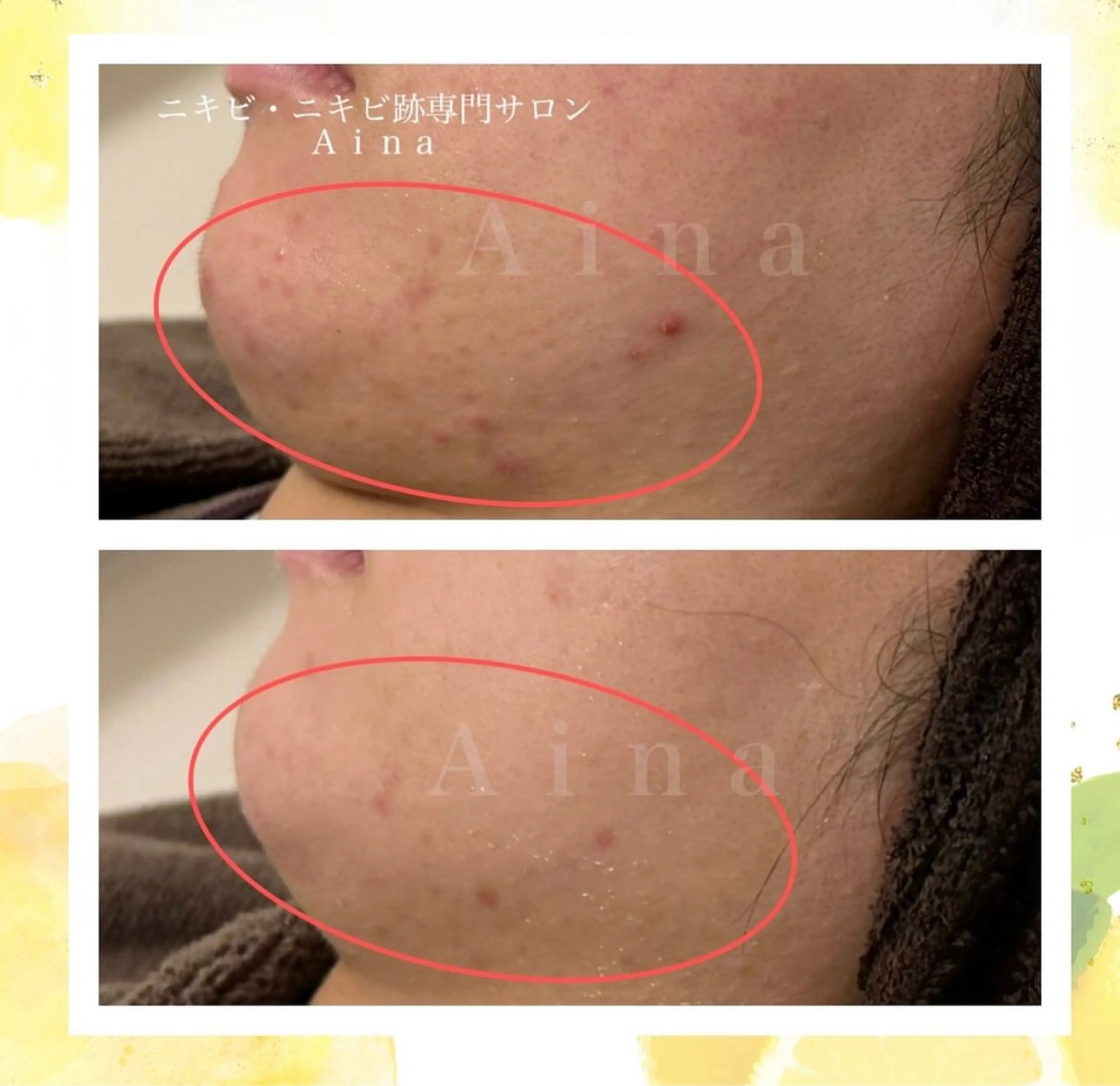 エステ リラク ニキビ跡専門サロン Ａｉｎａのエステ・リラクイメージ