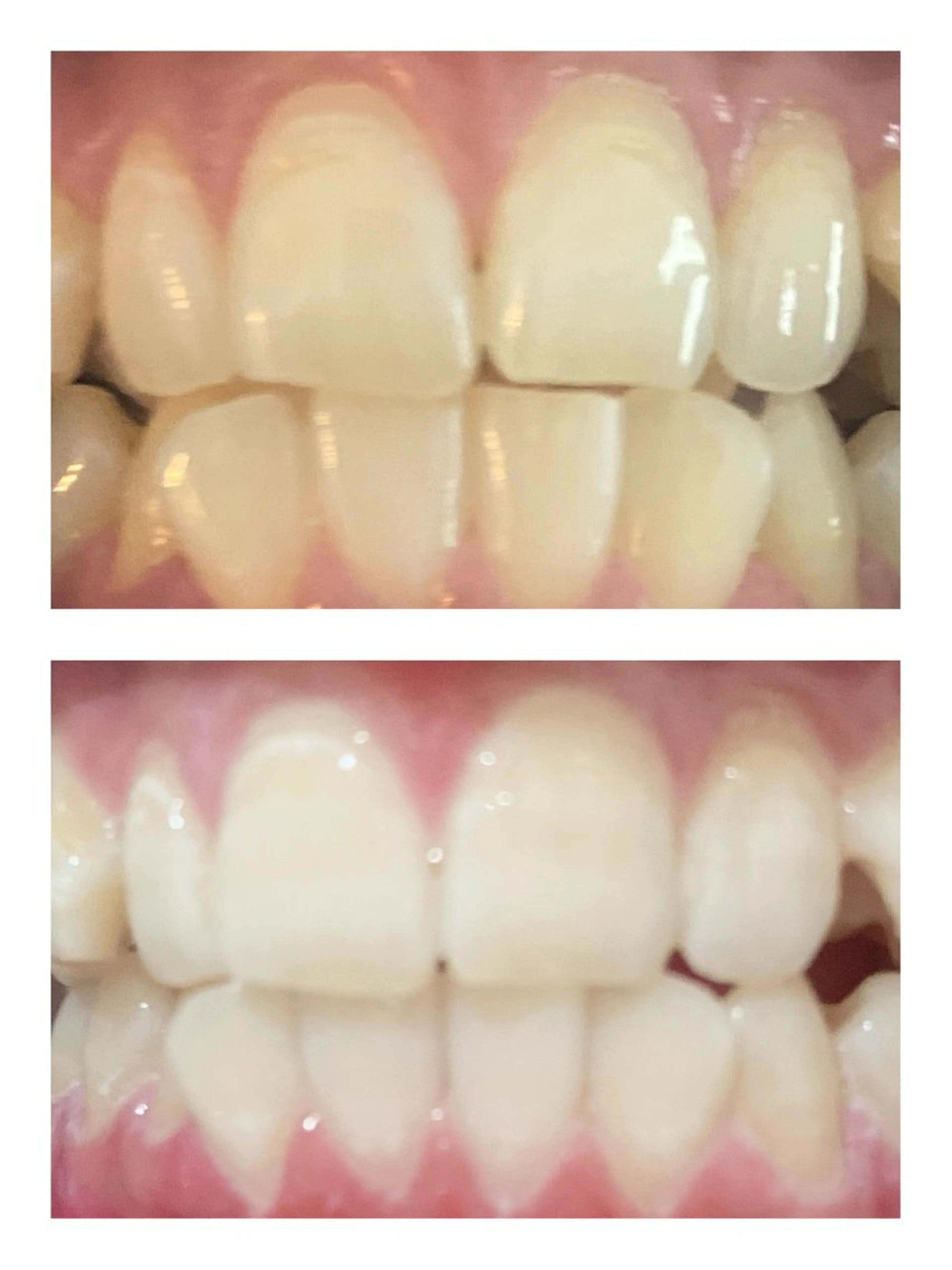 セルフホワイトニング🦷の写真