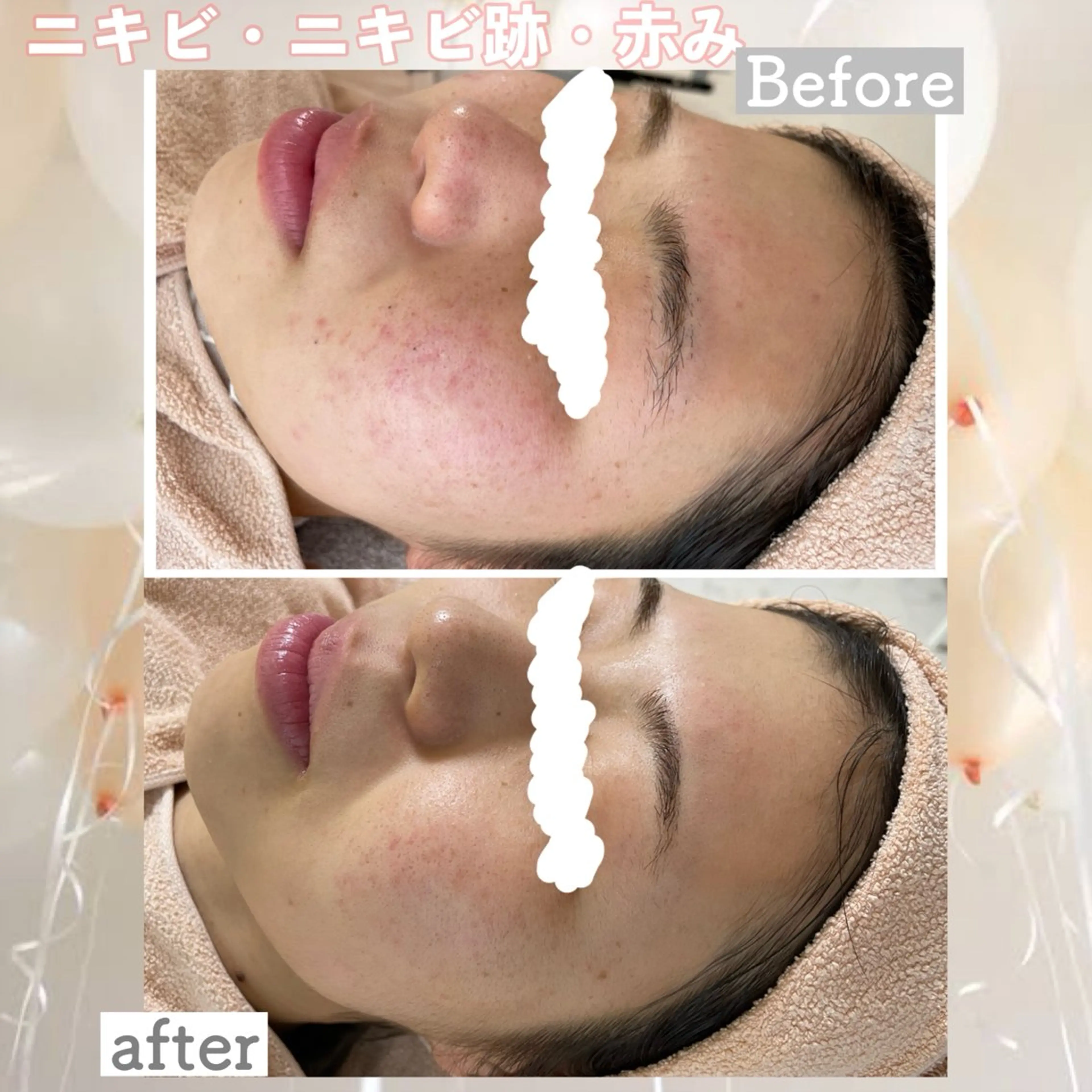 エステ ニキビ&跡改善サロン オーナー光木のエステ・リラクイメージ