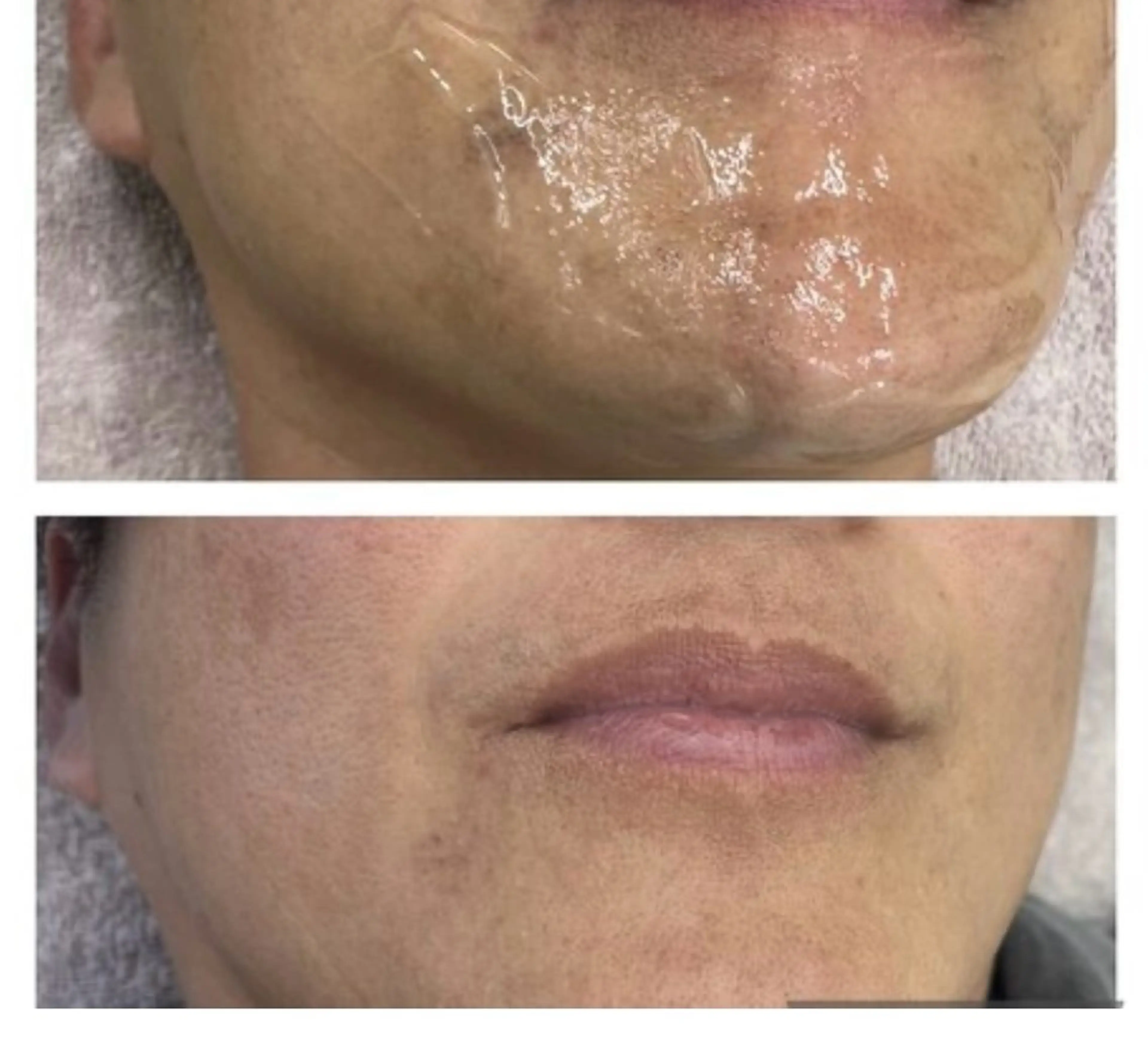 お試しメンズ髭脱毛の写真