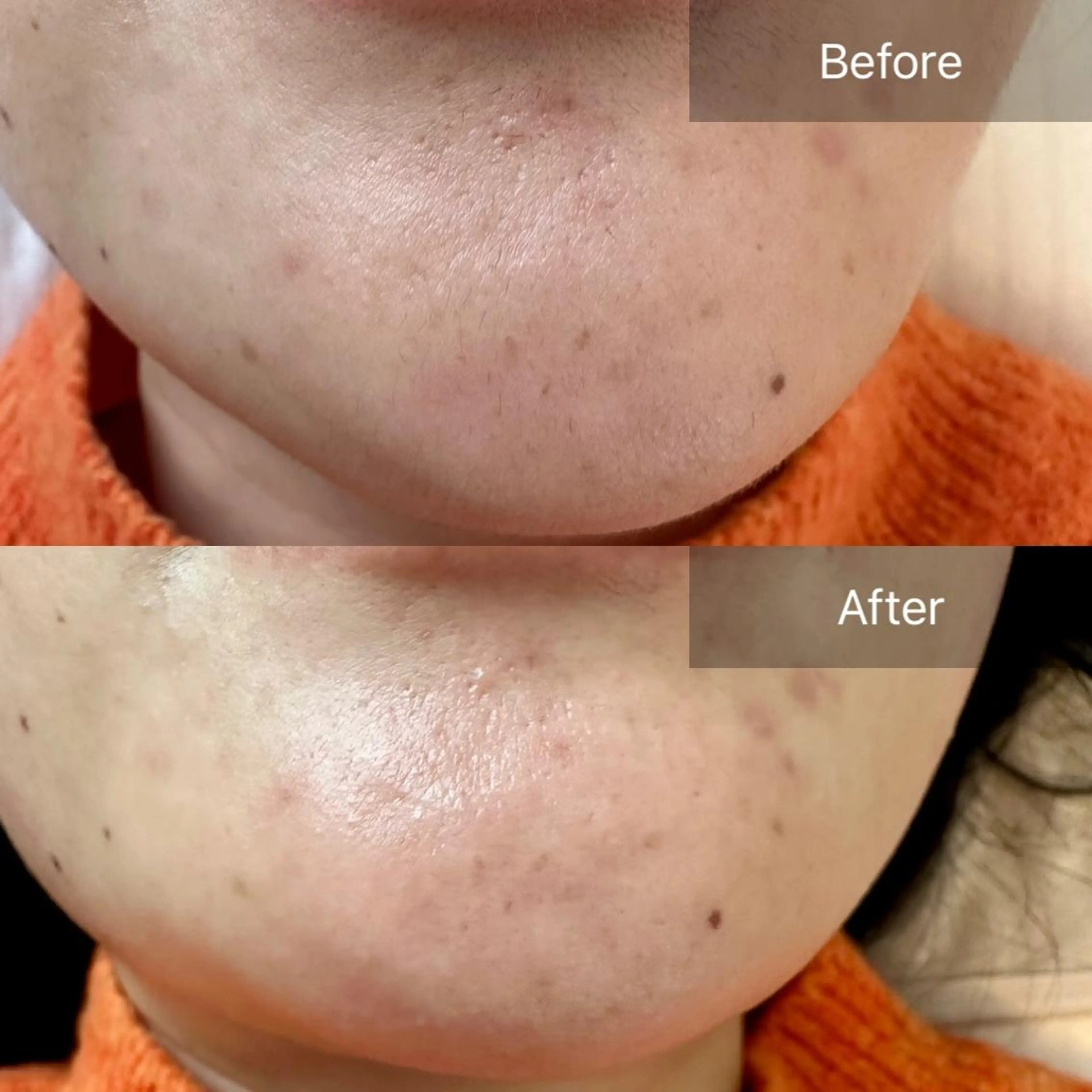 脱毛 Eminy. HITOMIのエステ・リラクイメージ