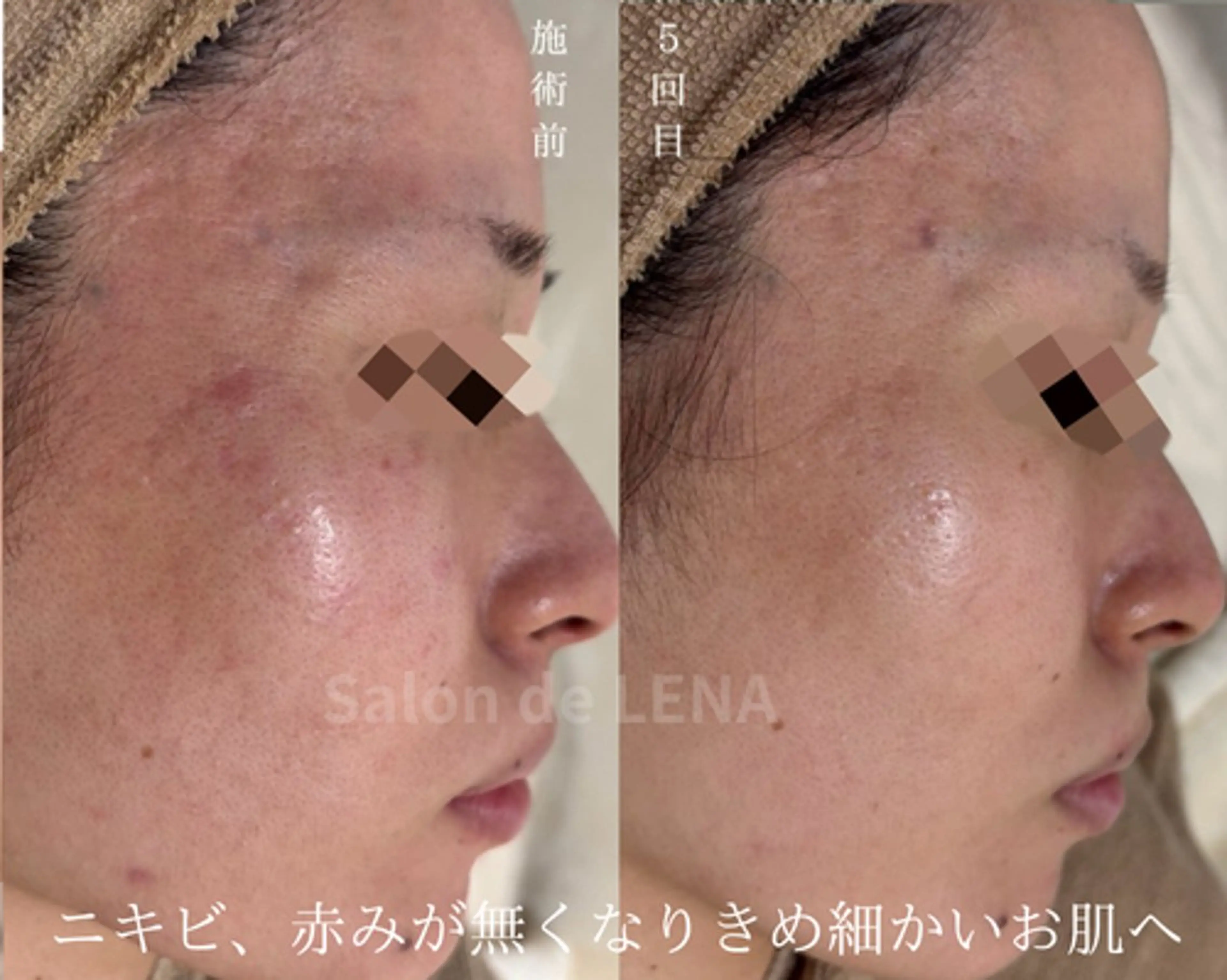 ハーブピーリング・毛穴ケア専門サロンSalon de LENA 栄店所属・ハーブピーリング専門 サロンドレナ　白藤のエステ・リラクイメージ