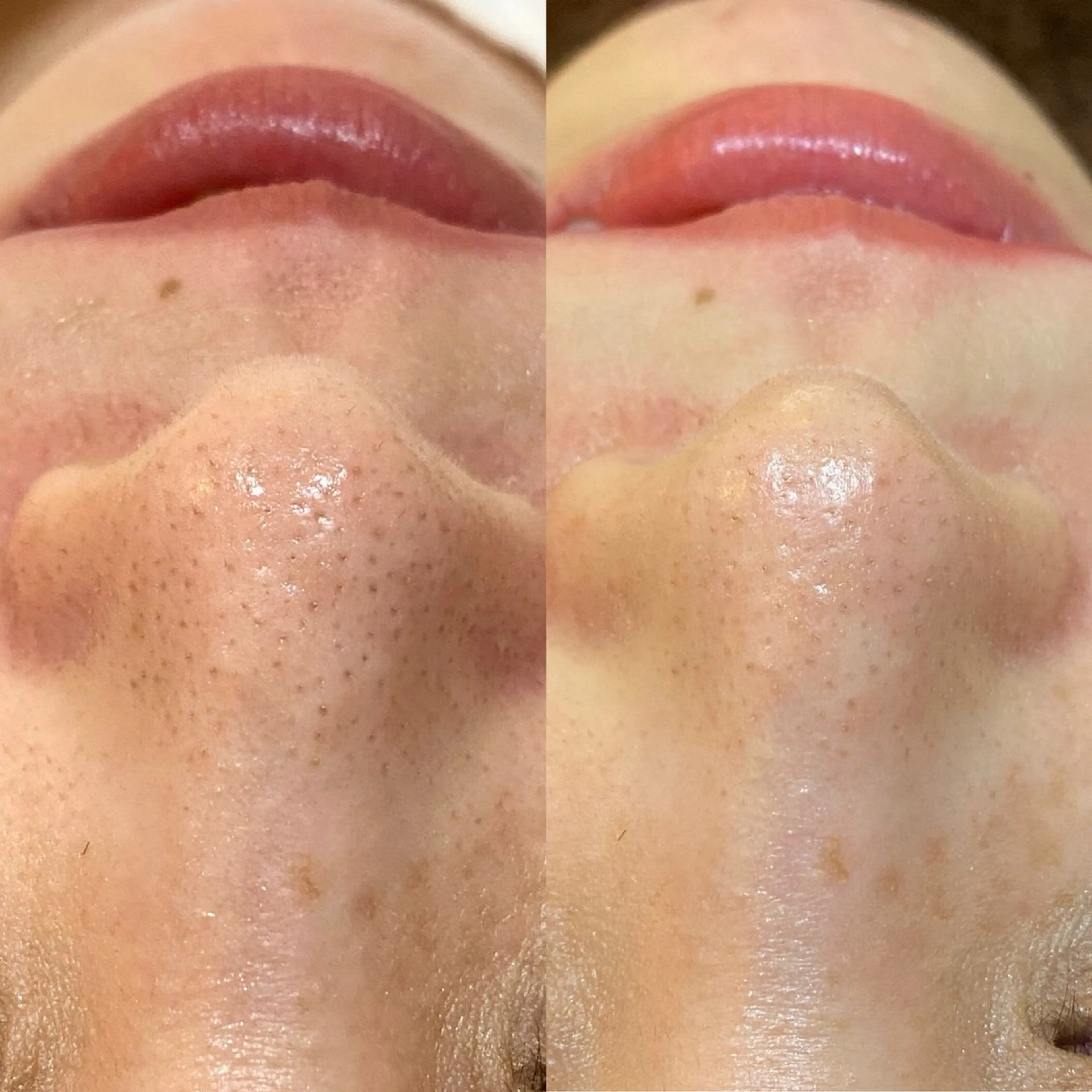 ご新規様限定✨毛穴に特化✨『シェービング&ハイドラフェイシャル』通常¥11,980メニューがこの価格🉐の写真