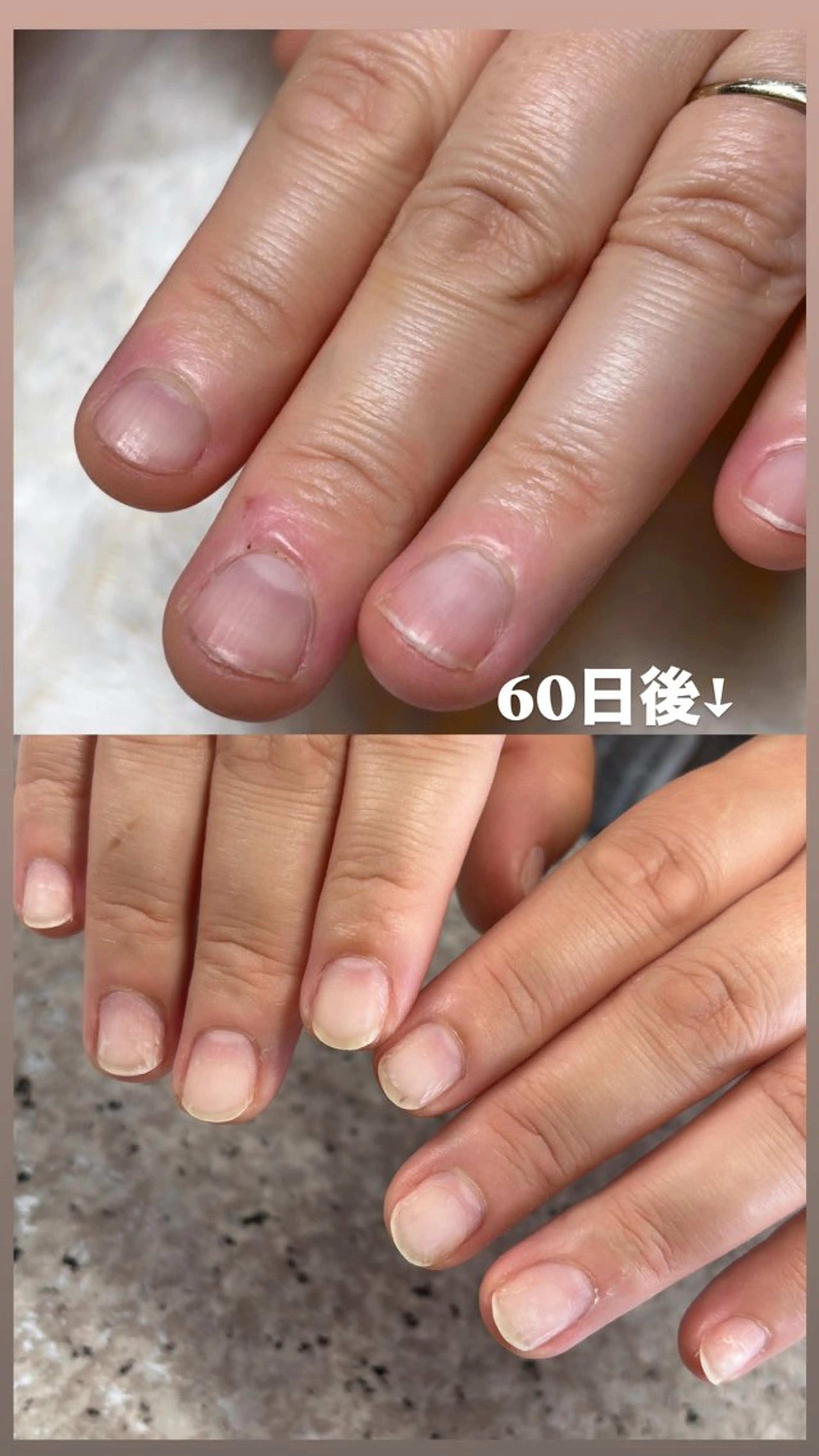 9割のお客様が成功！👏噛み癖・深爪さようなら👋🏻の写真