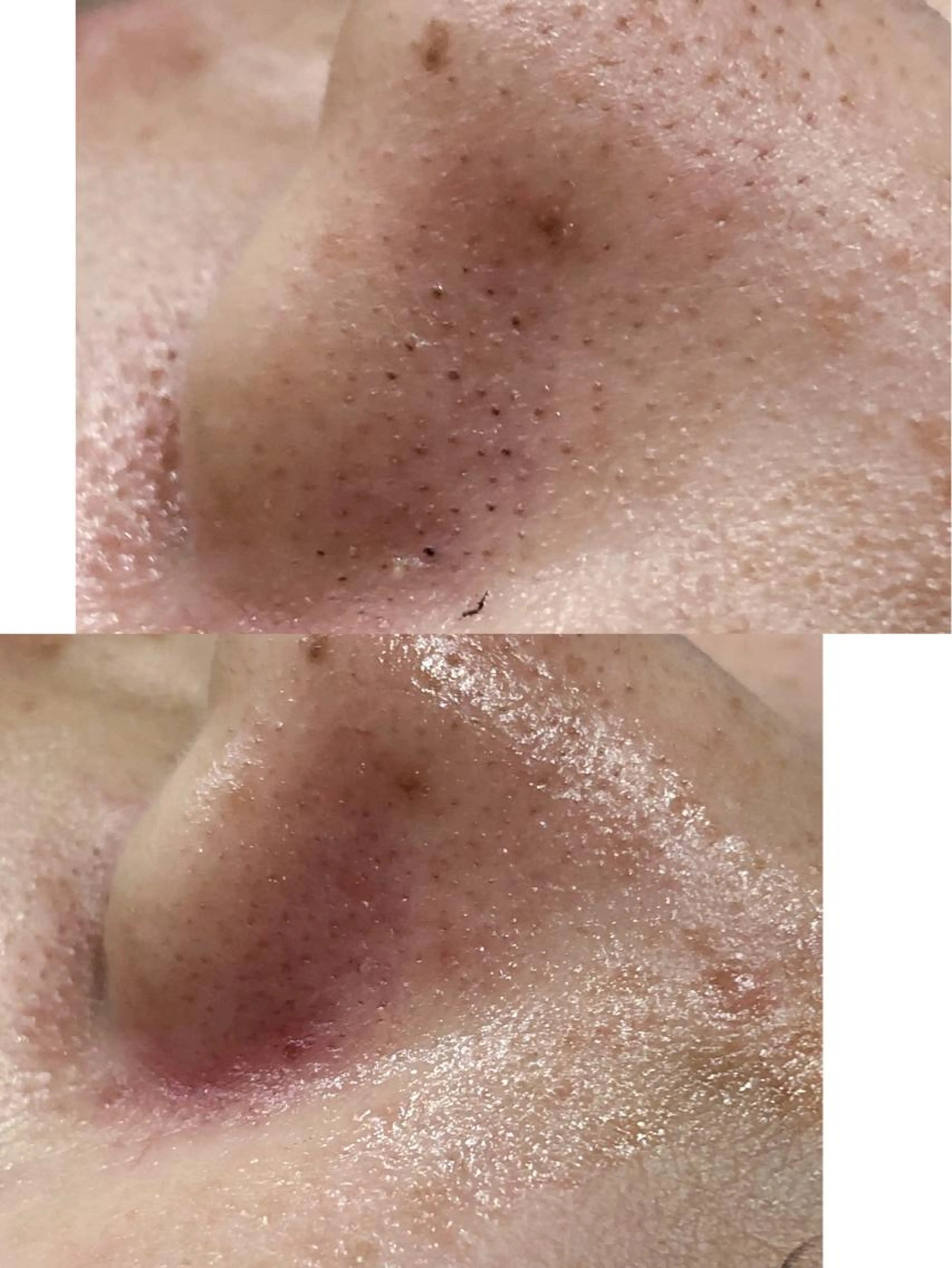 ✨【角栓除去＆毛穴大洗浄】　　　　　50分¥12980➡️￥5980の写真