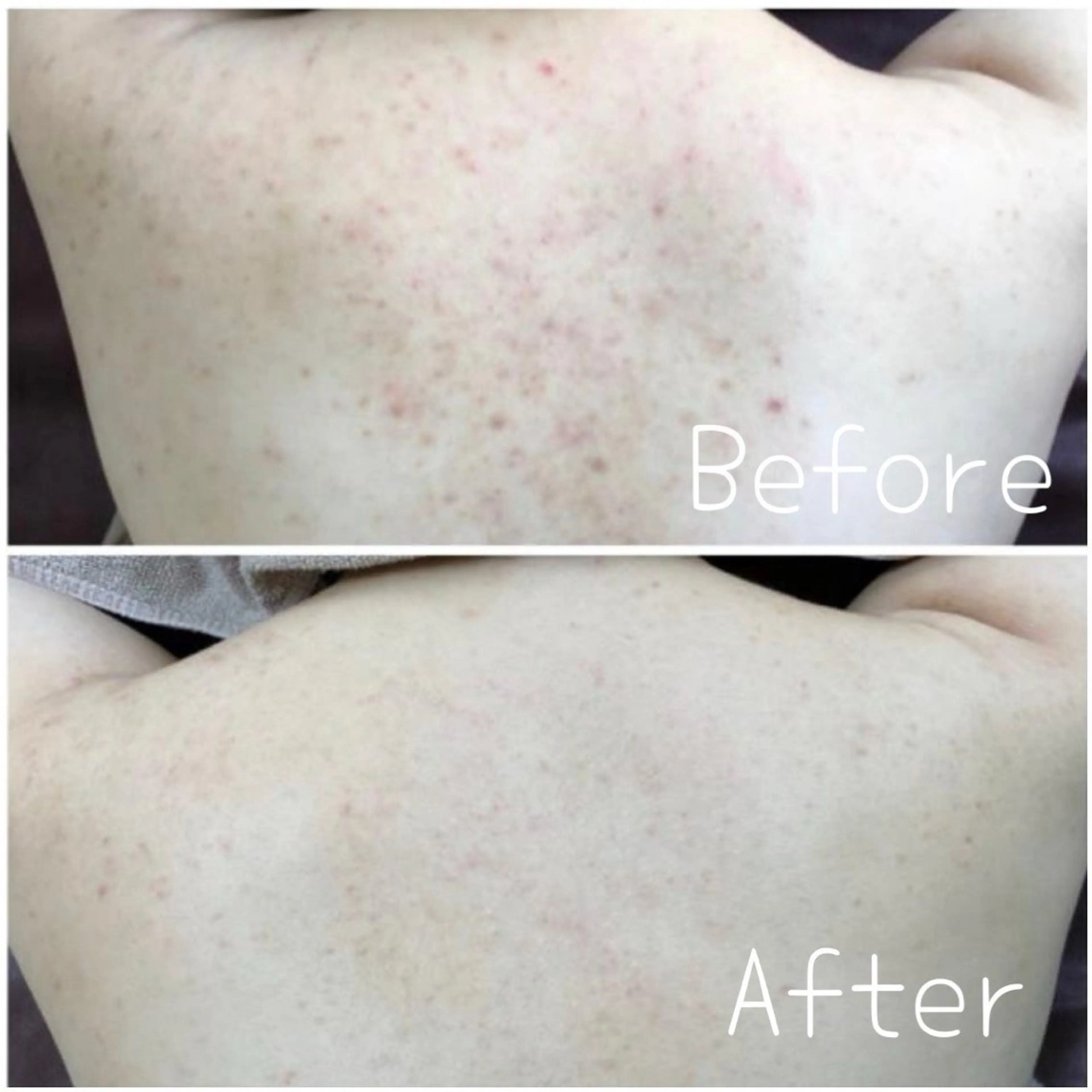 《背中ニキビ/肌質改善/美白/エステ》背中全体ハーブピーリングの写真