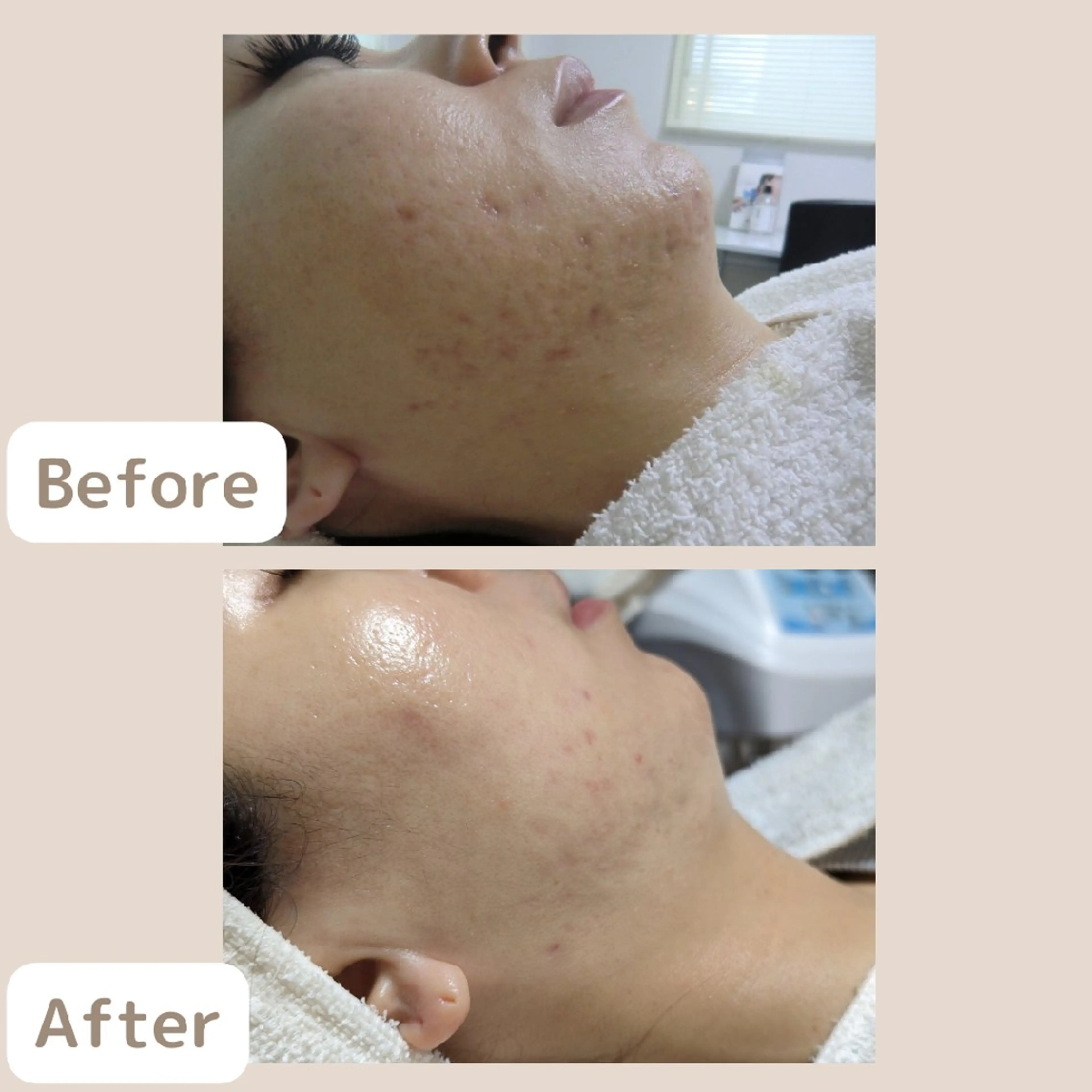 メンズ レチノール/ニキビ/ 毛穴ケア　浅川のエステ・リラクイメージ