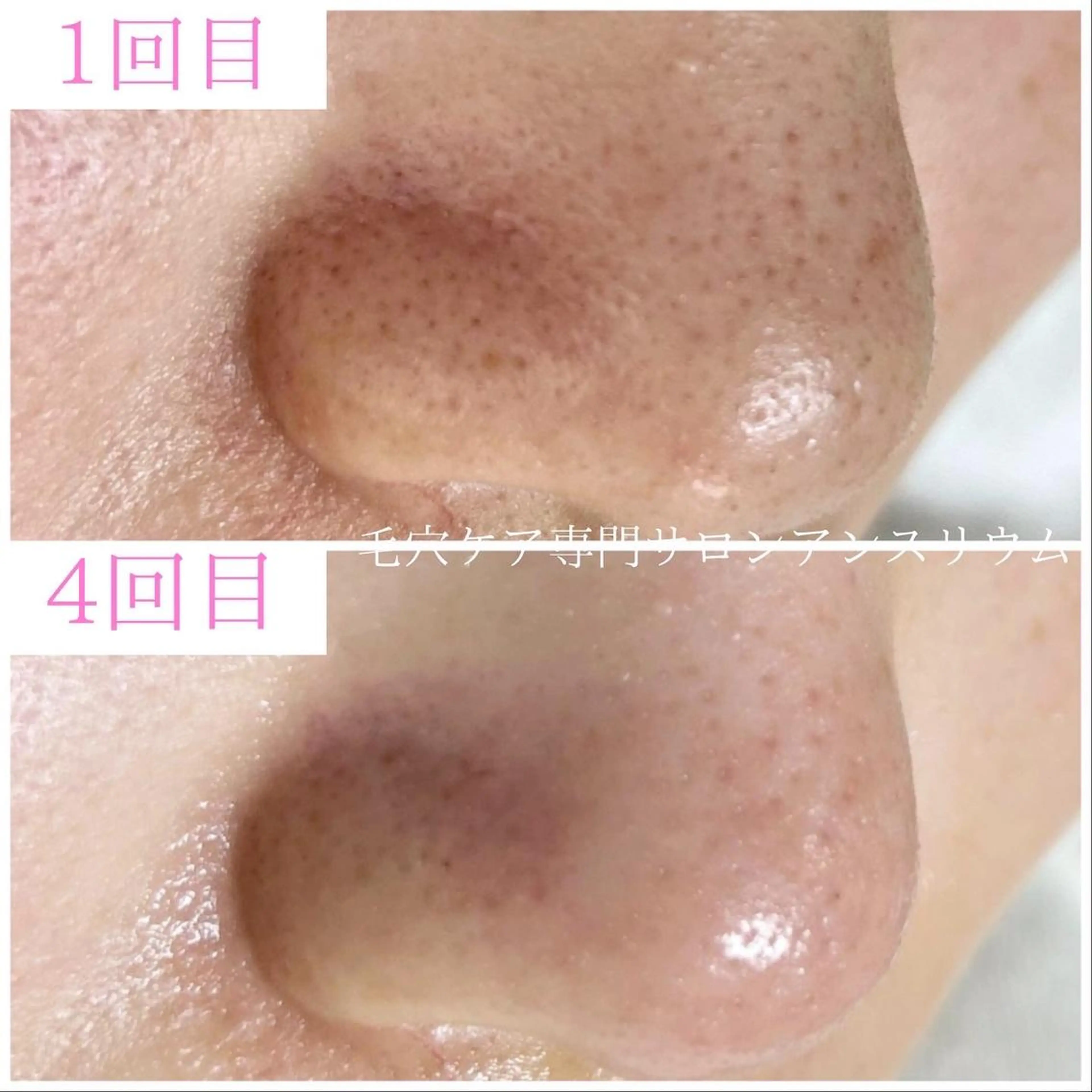 毛穴ケア専門サロンアンスリウム所属・茨城土浦 つくば毛穴 ケア専門サロンのエステ・リラクイメージ