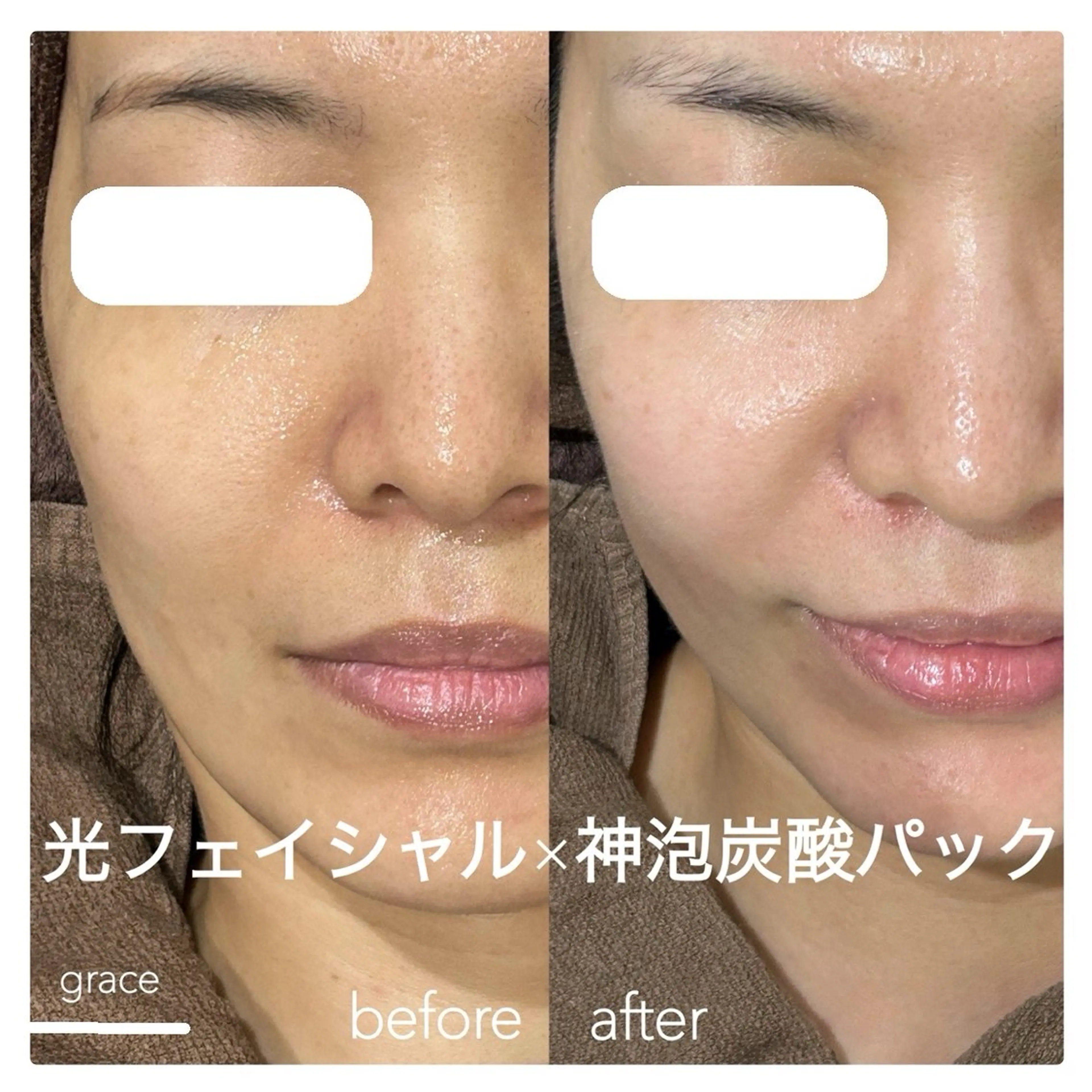 🦢平日限定🦢光フェイシャル🫧神泡炭酸パック付き！ハリツヤ、透明感up！の写真