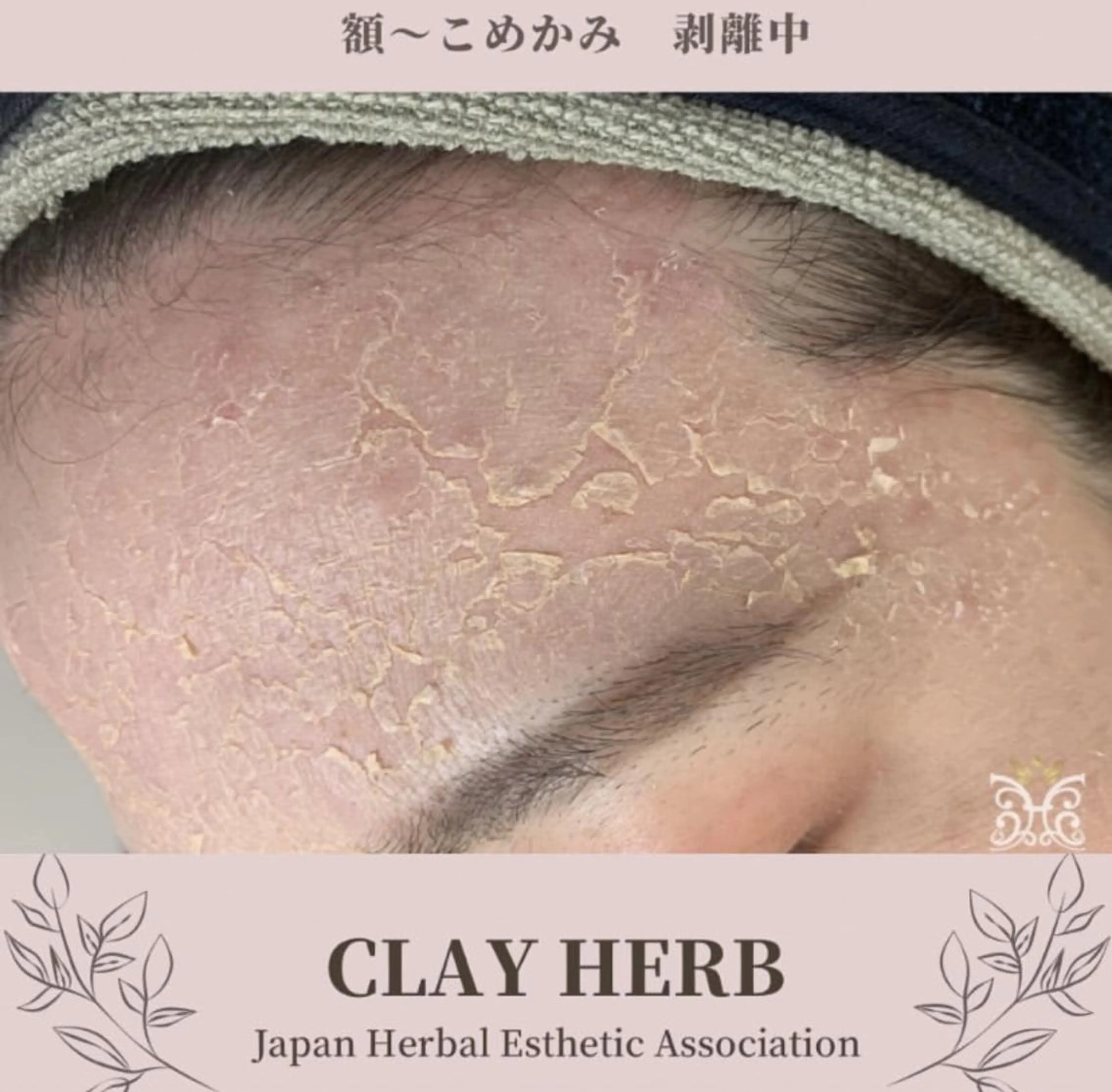 【ハーブピーリング&アロマリンパマッサージ nana】医療提携サロン所属・美肌&アロマ🌸 nana 中目黒のエステ・リラクイメージ