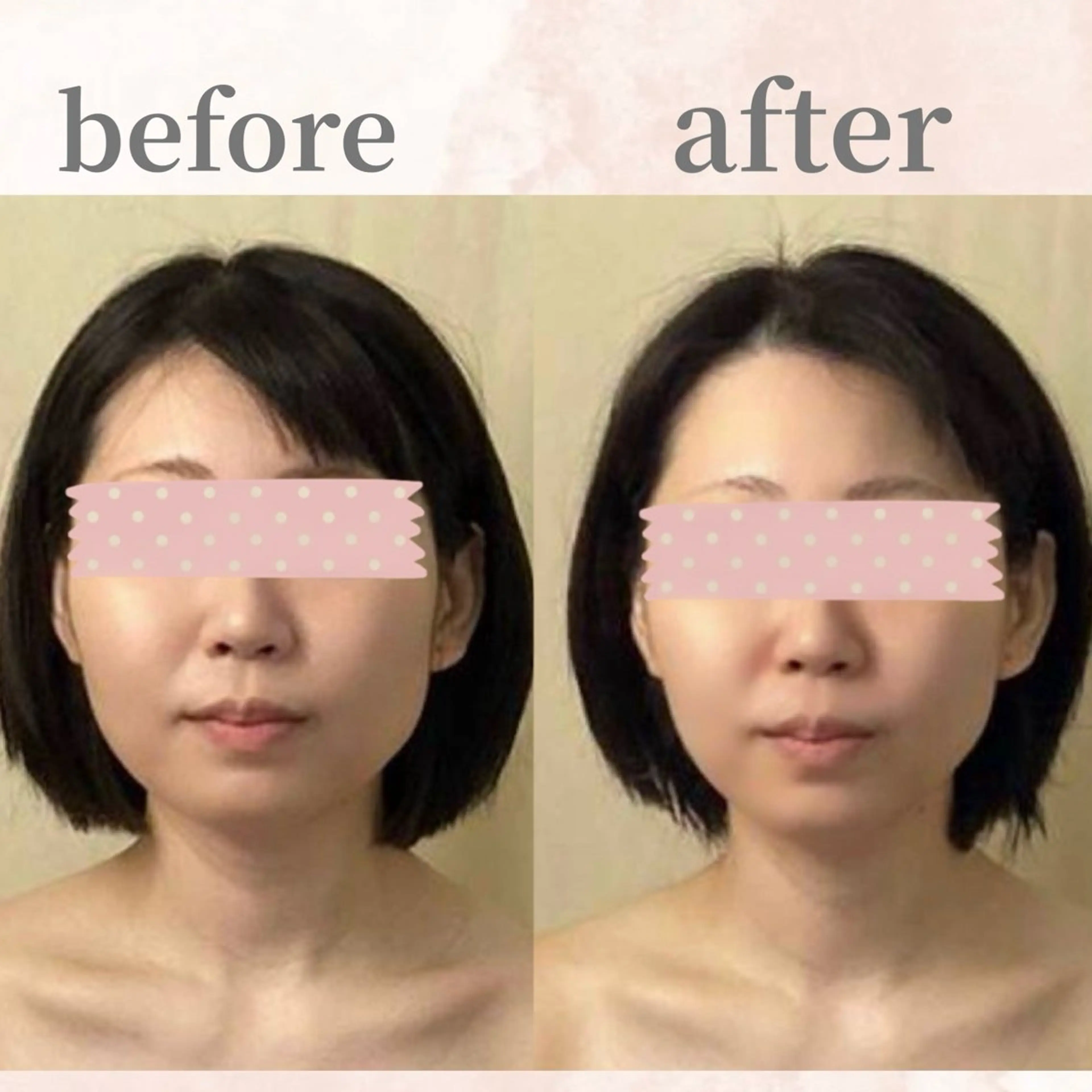 潤いツヤ肌☆憧れ韓国女優肌に♪【コラーゲン産生ラジオ波コース】の写真