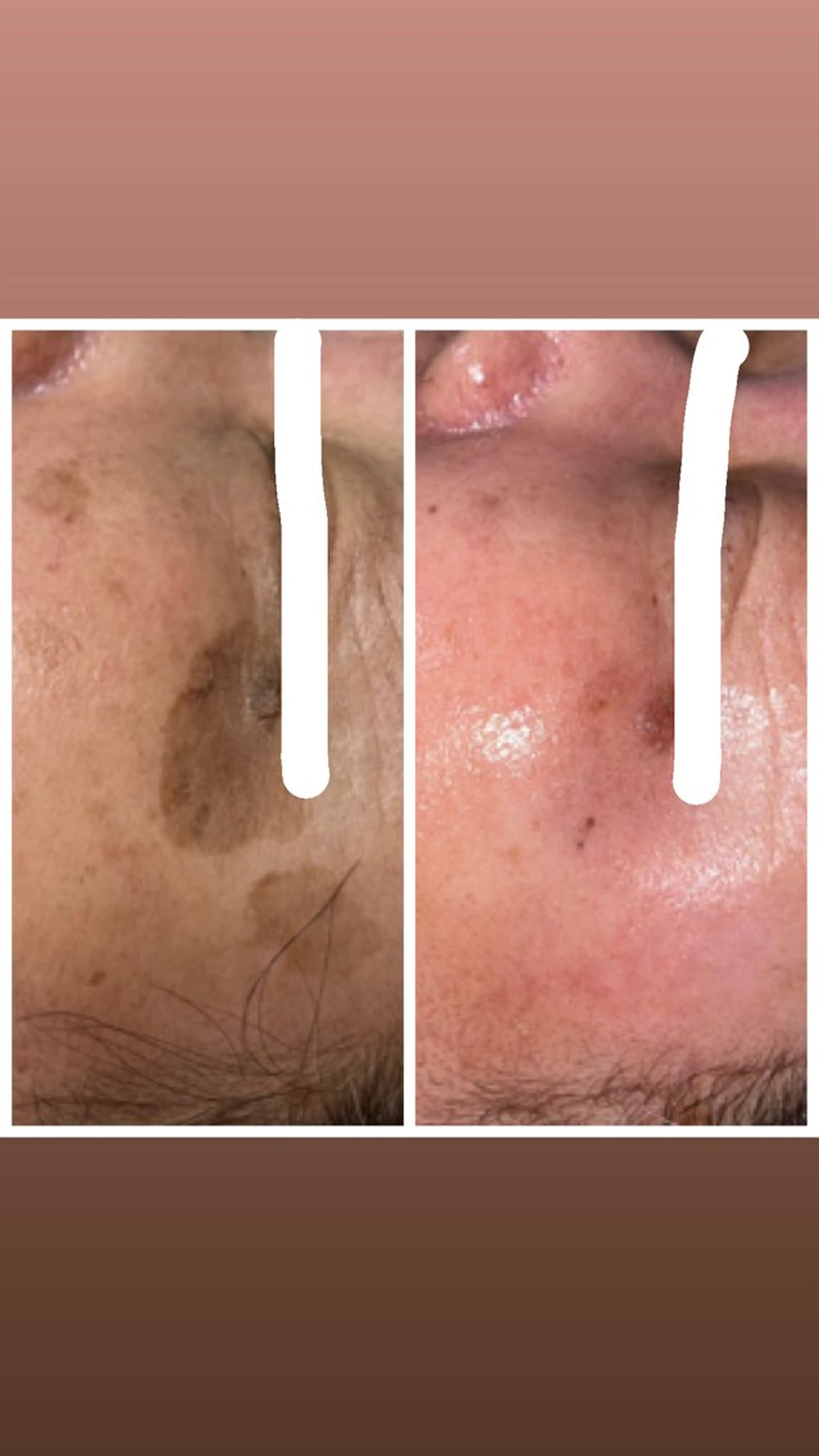 エステ 【ハーブピーリング】 Allumentのエステ・リラクイメージ