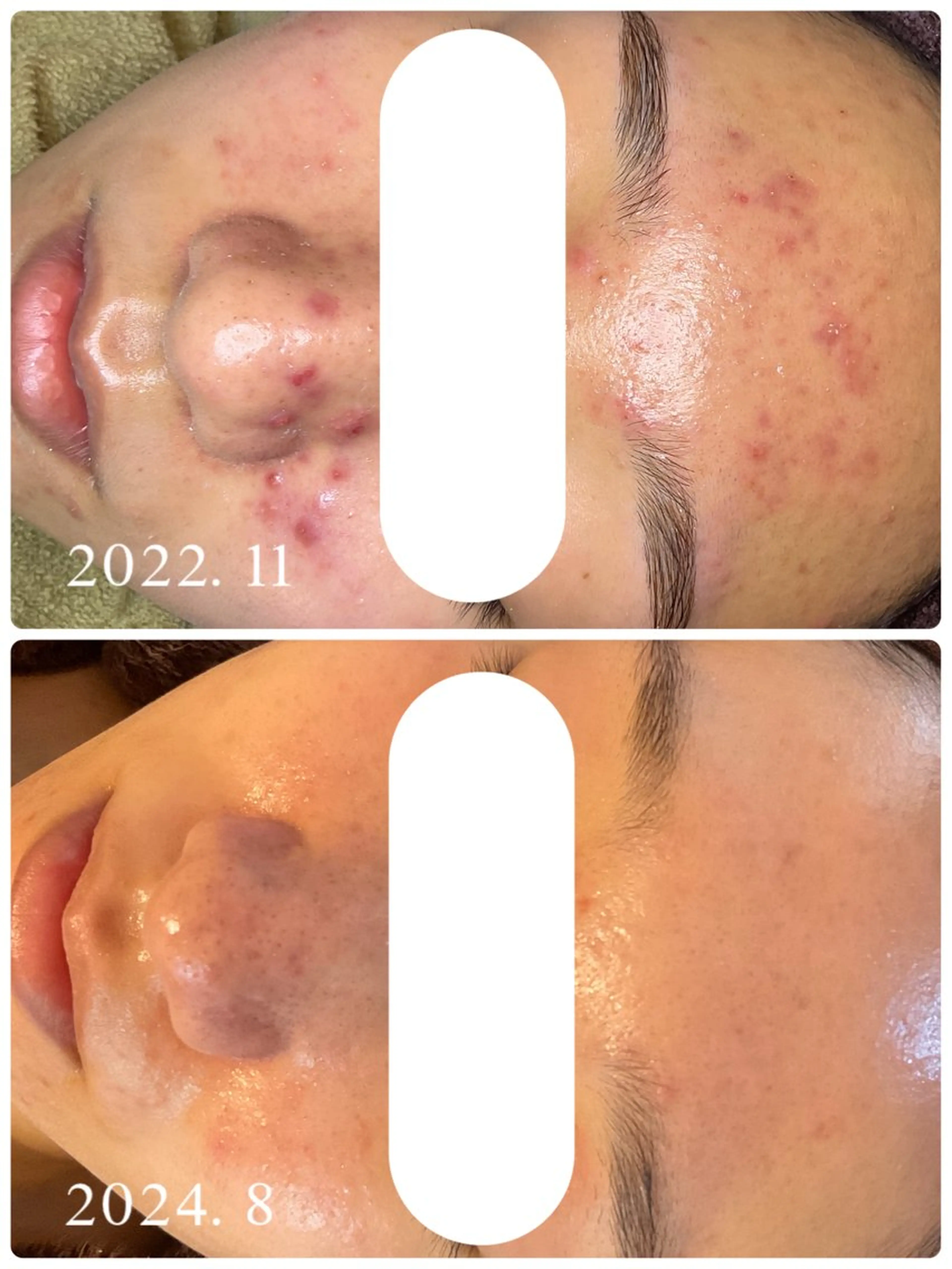 【🌿人気No.1🌿】肌質変えたい方必見‼︎陶肌トリートメント✨剥離なし・痛みなし・ダウンタイムなし🎀当日メイク🆗の写真