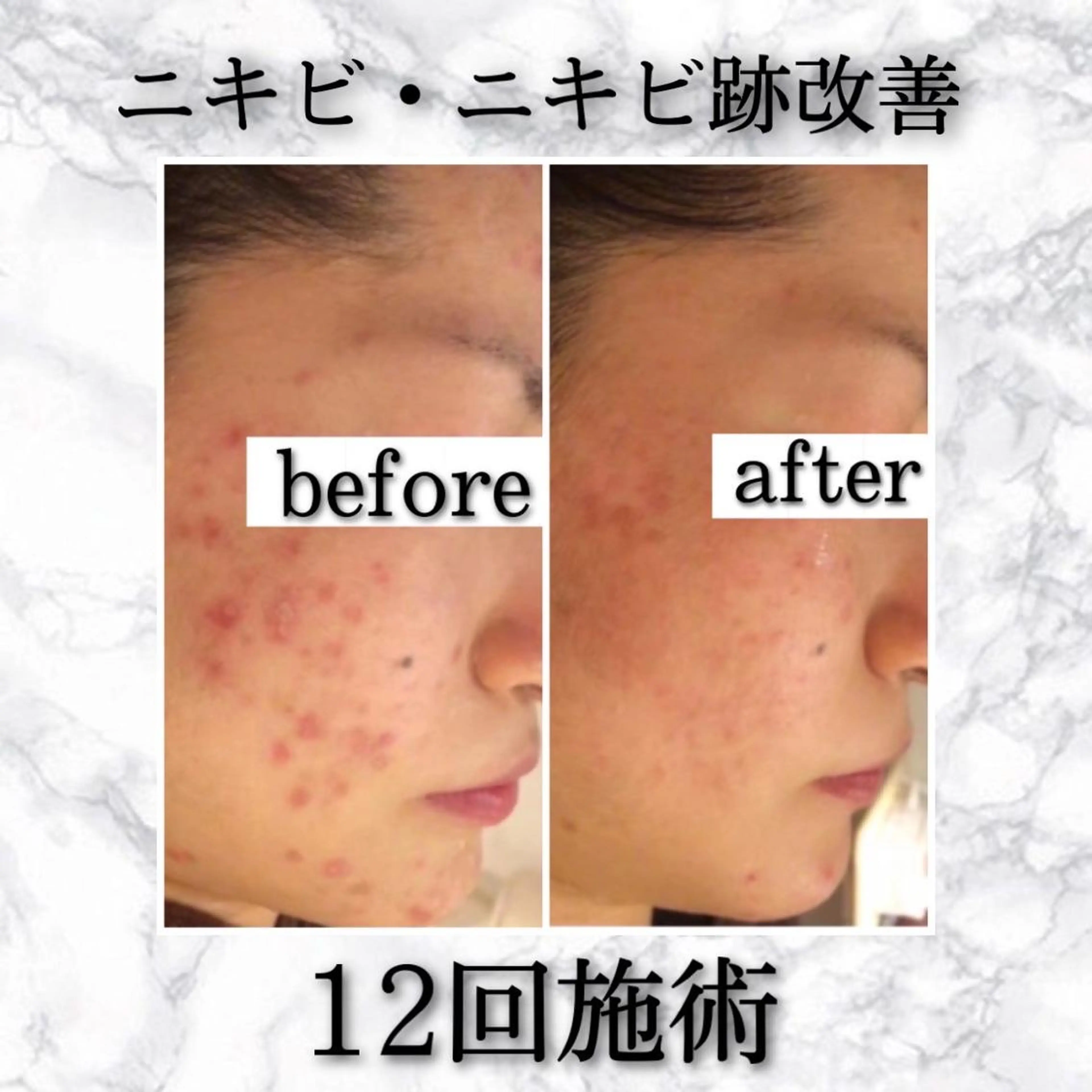 ミディアム カラー パーマ ヘアアレンジ メンズ キッズ ネイル マツエク・マツパ アイブロウ 夏までに肌荒れ卒業 するサロン🌻のエステ・リラクイメージ