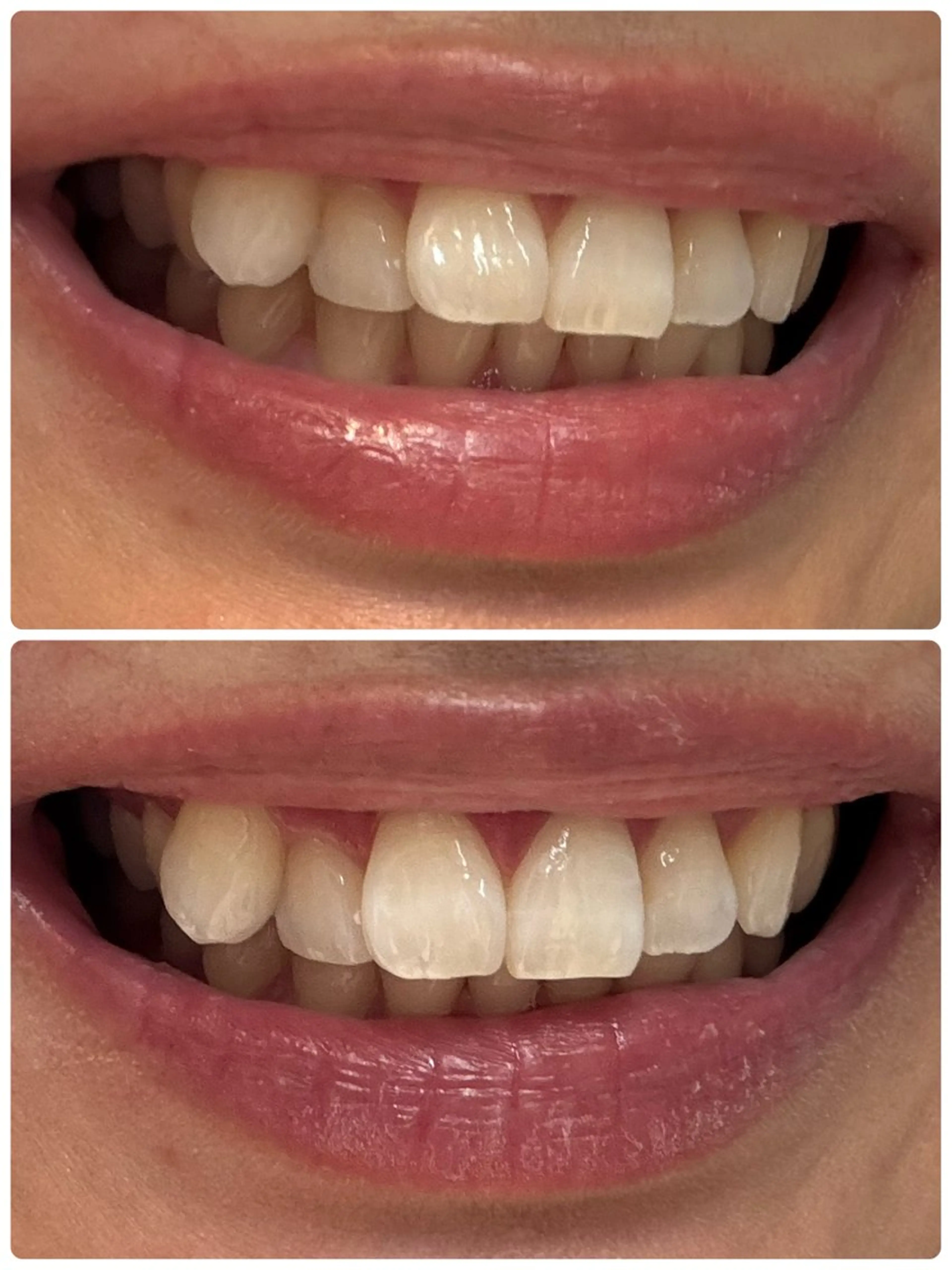 セルフホワイトニング　20分X1照射の写真