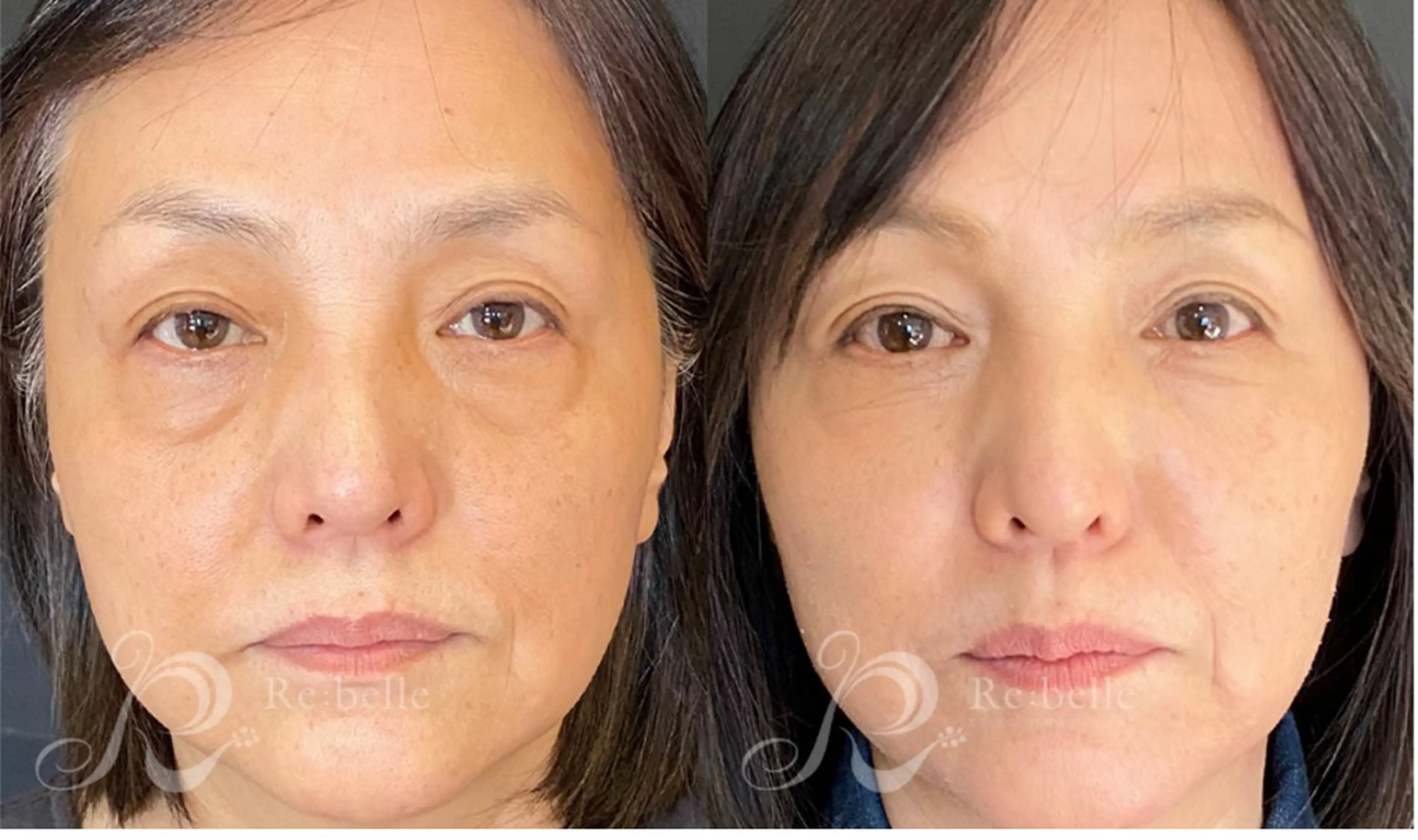 【肌質改善】リベルハーブリーリング ¥55000→¥22000の写真