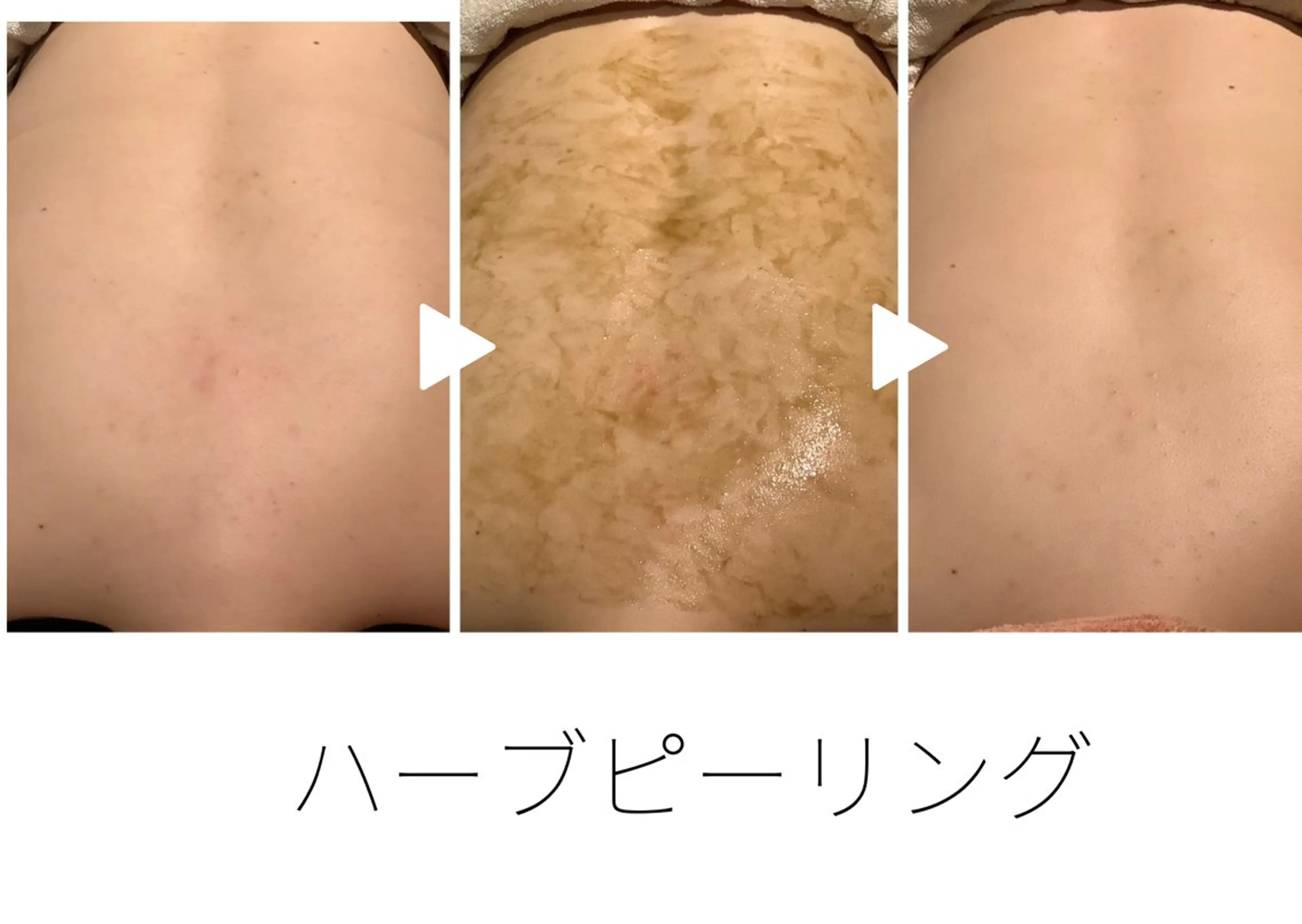 ブライダルにオススメ🍀ハーブピーリング🍀背中、二の腕のブツブツ肌質改善/背中全体&二の腕トリートメントの写真