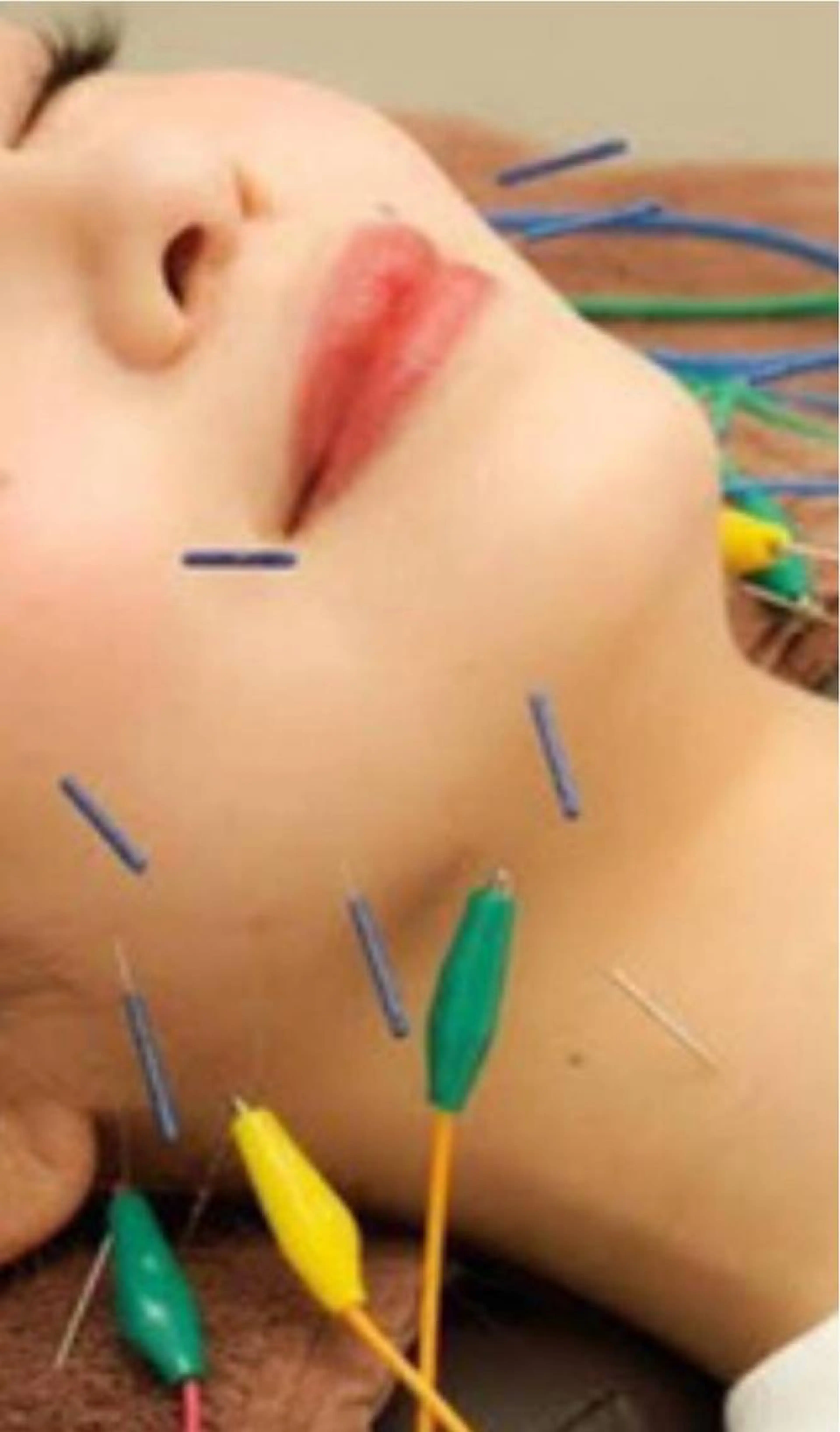 リフトアップハリネズミちゃん＆超音波リフトアップの写真