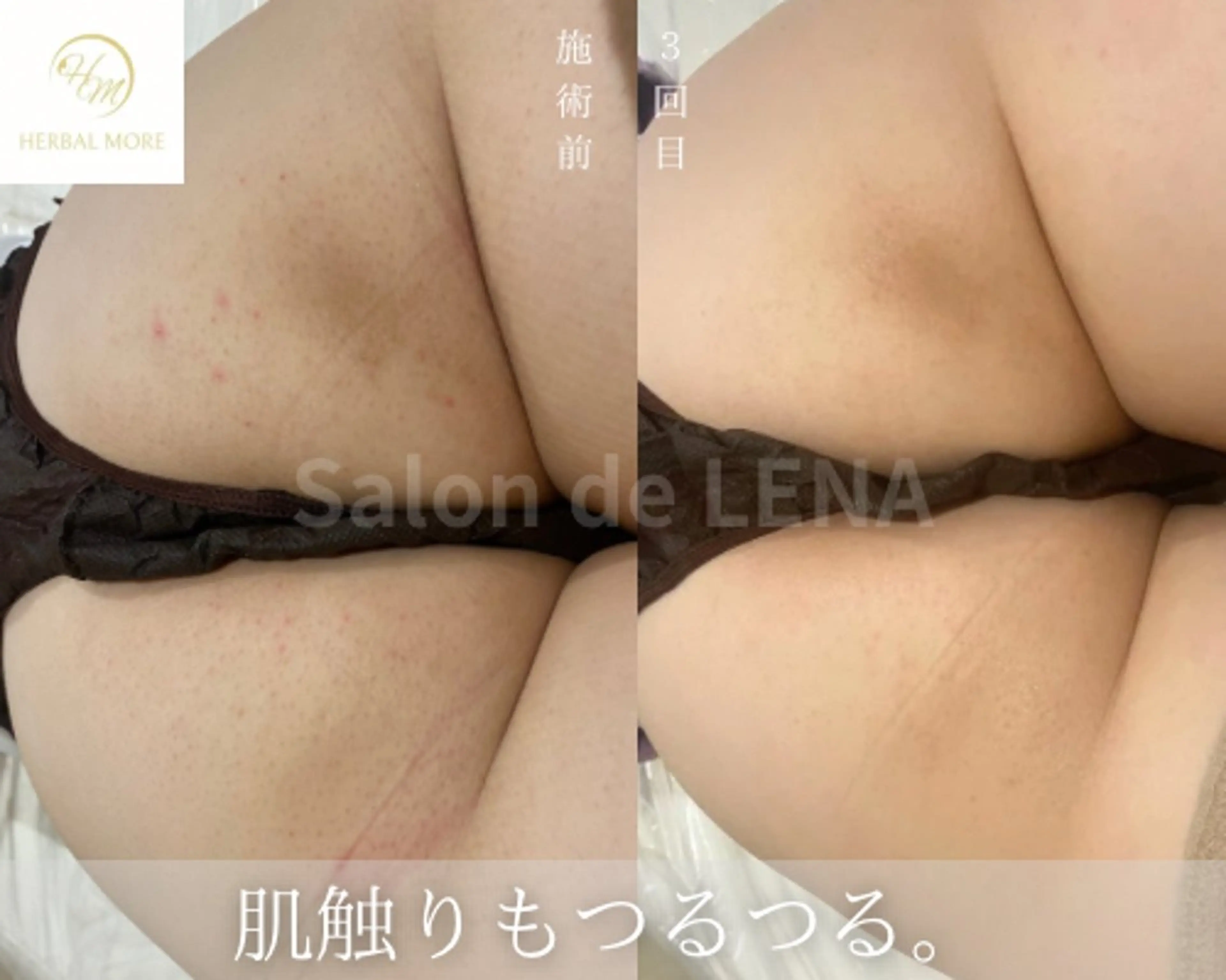 【お尻ハーブピーリング/剥離有・無】ニキビケア、色素〇着、毛穴、サメ肌の写真