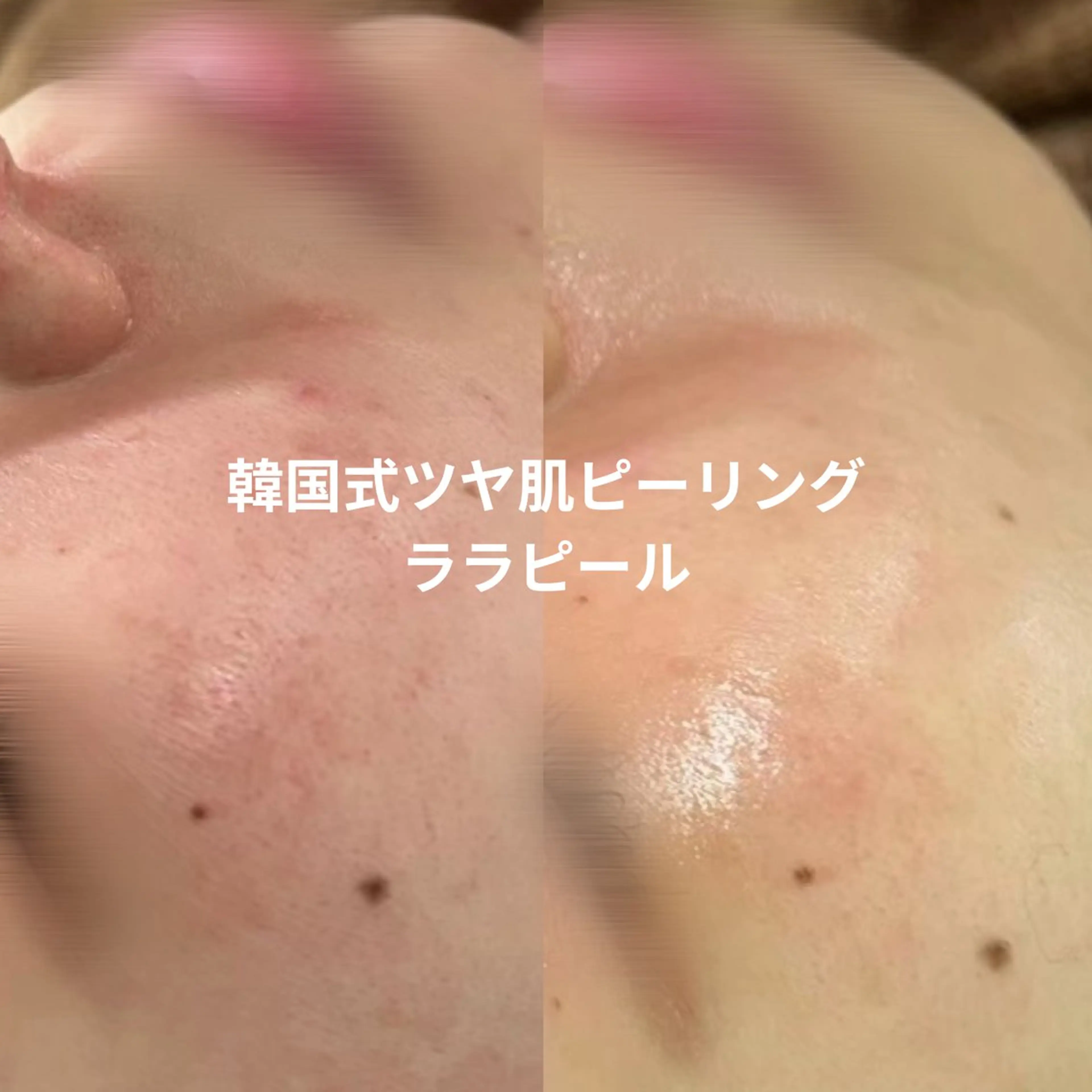 ララピール|優しいピーリングでつるん肌への写真