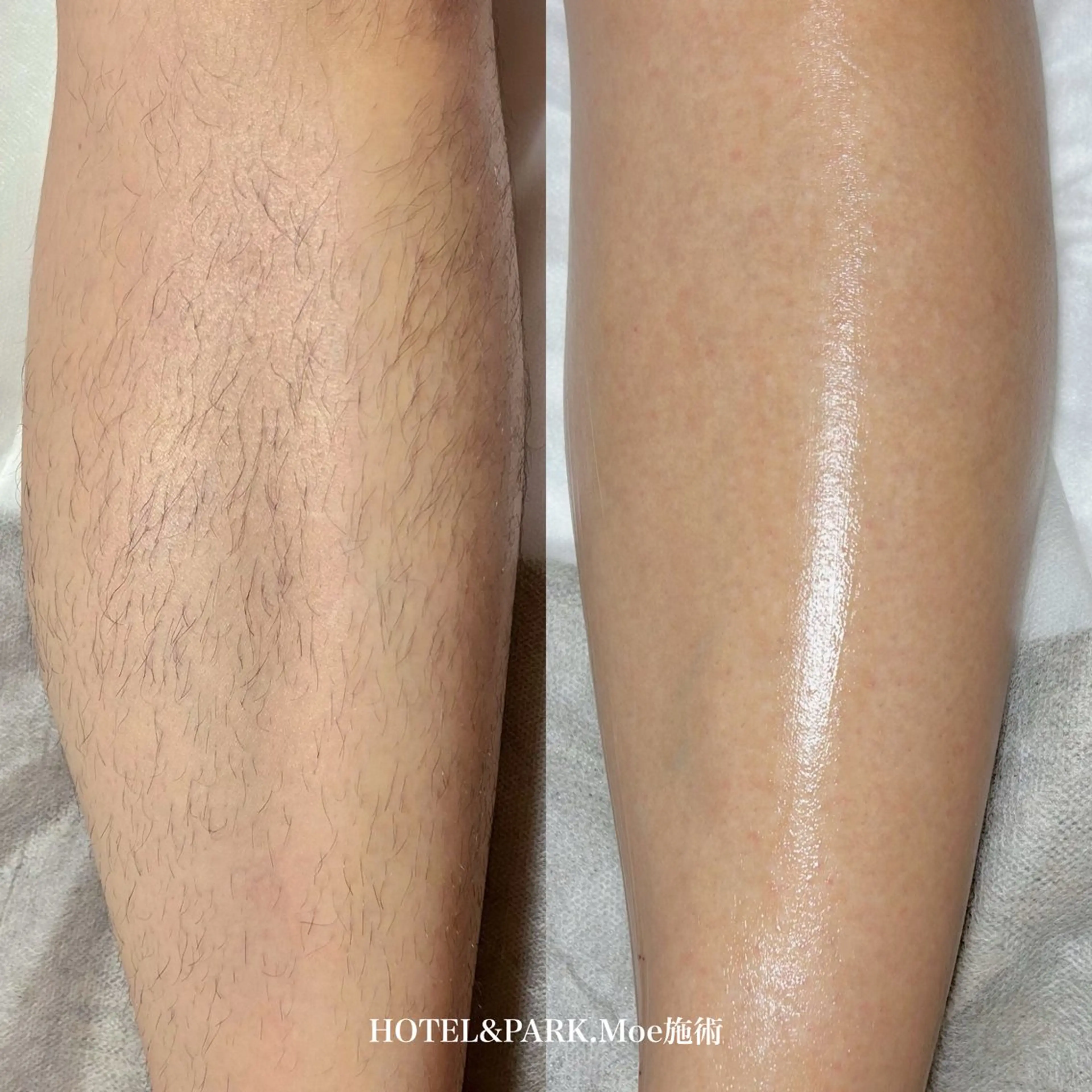 HOTEL&PARK . ワックス脱毛のエステ・リラクイメージ