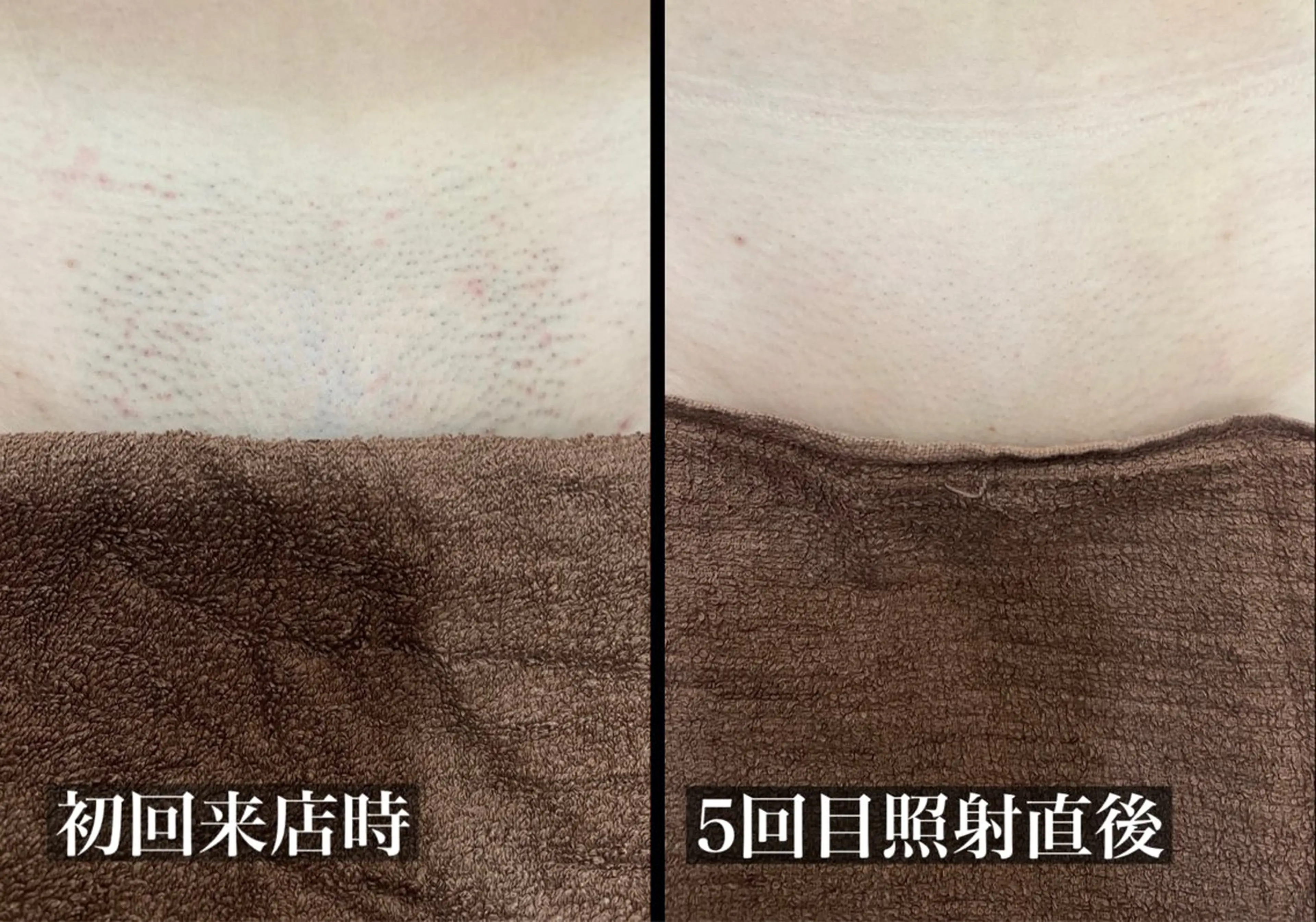 脱毛 毛穴改善/脱毛 ネイル　川上久仁子のエステ・リラクイメージ