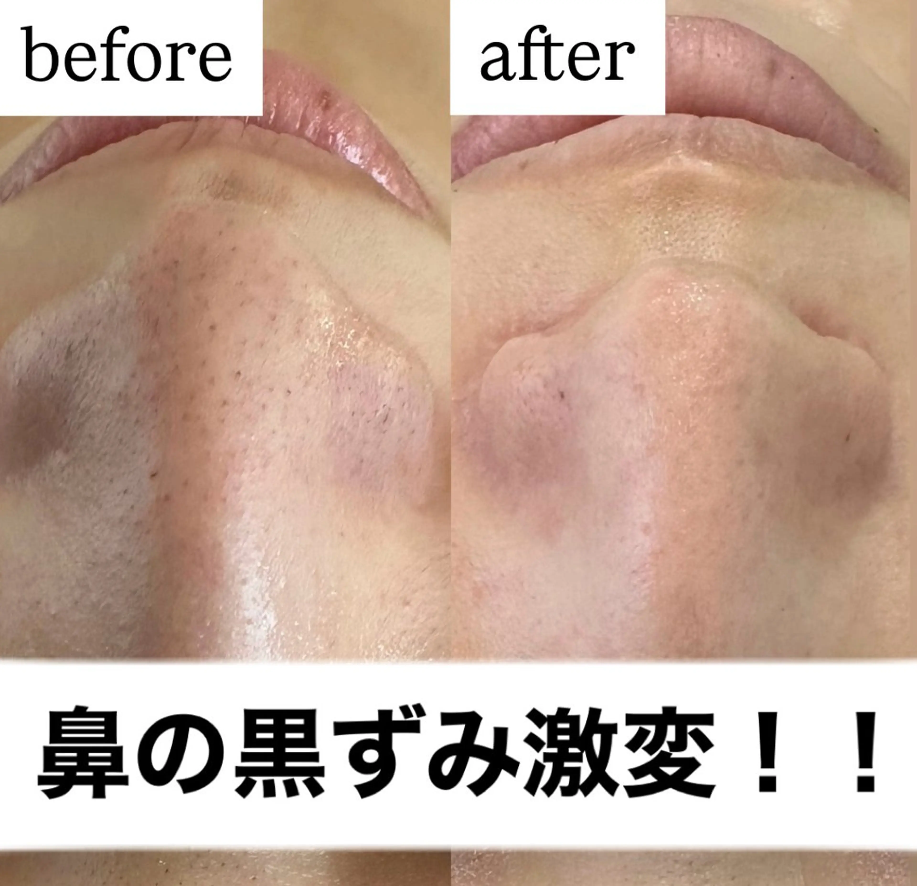 【簡単で綺麗に！！】Tゾーン👃毛穴洗浄　¥4,500→¥3,980の写真