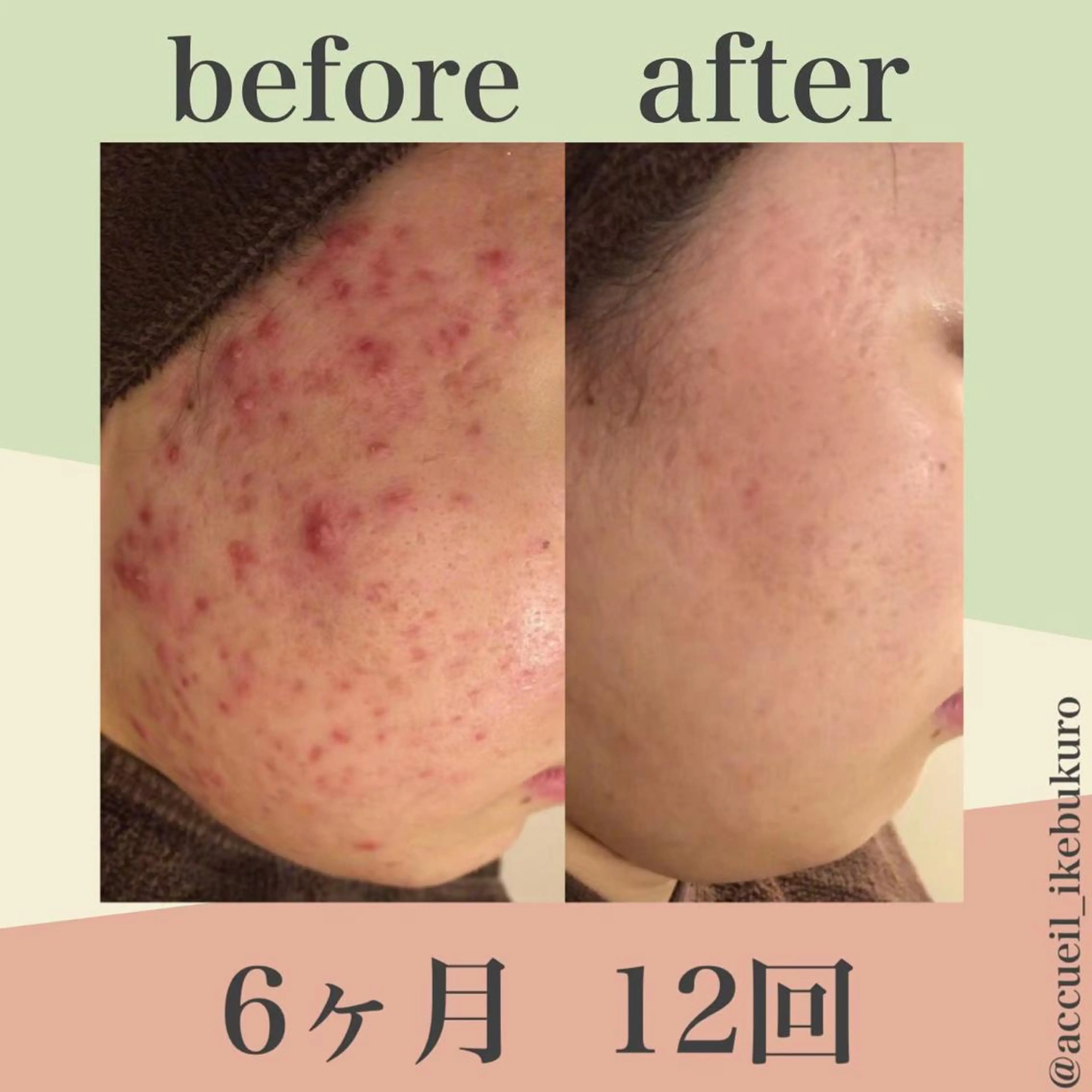 ミディアム カラー パーマ ヘアアレンジ メンズ キッズ ネイル マツエク・マツパ エステ リラク ニキビ・肌質改善専門 ♡人生が変わるサロンのエステ・リラクイメージ