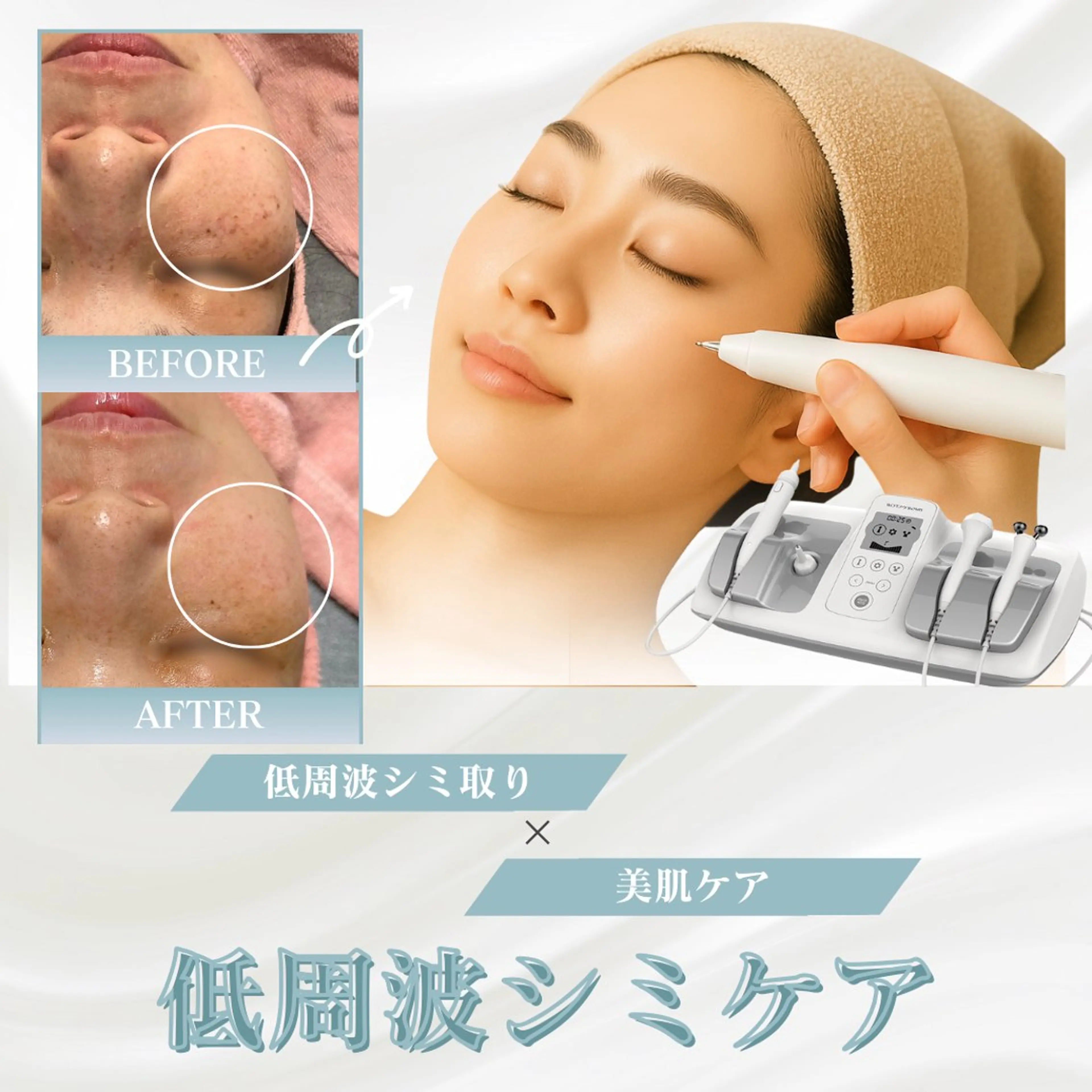【明日17日1名様限定❗️】低周波シミ取り20分間当て放題◎1週間でポロッと排出✨【シミ/そばかす/ニキビ跡に◎】の写真