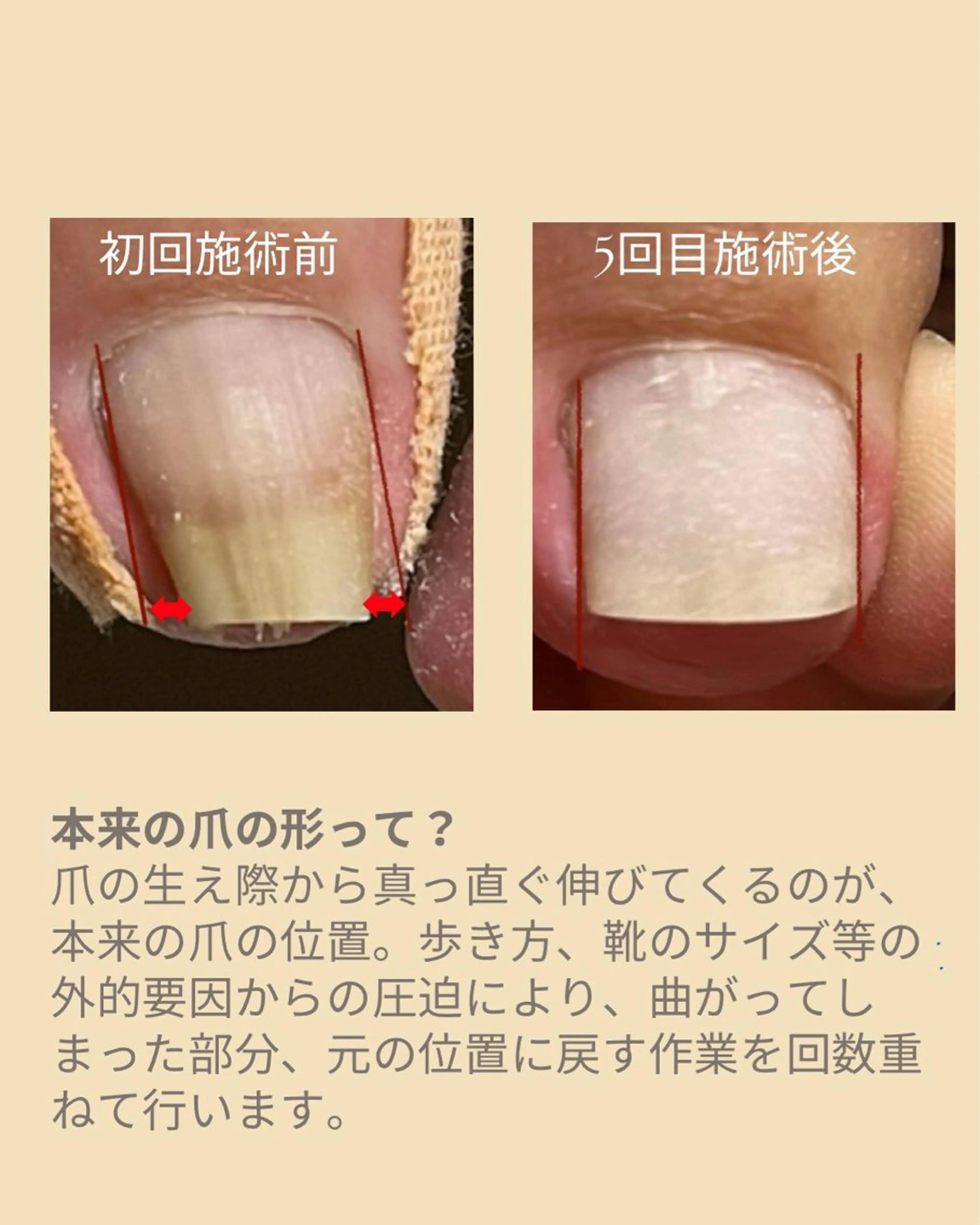 ネイル フットネイル ダンラップ新里 友簣乃のネイルデザイン