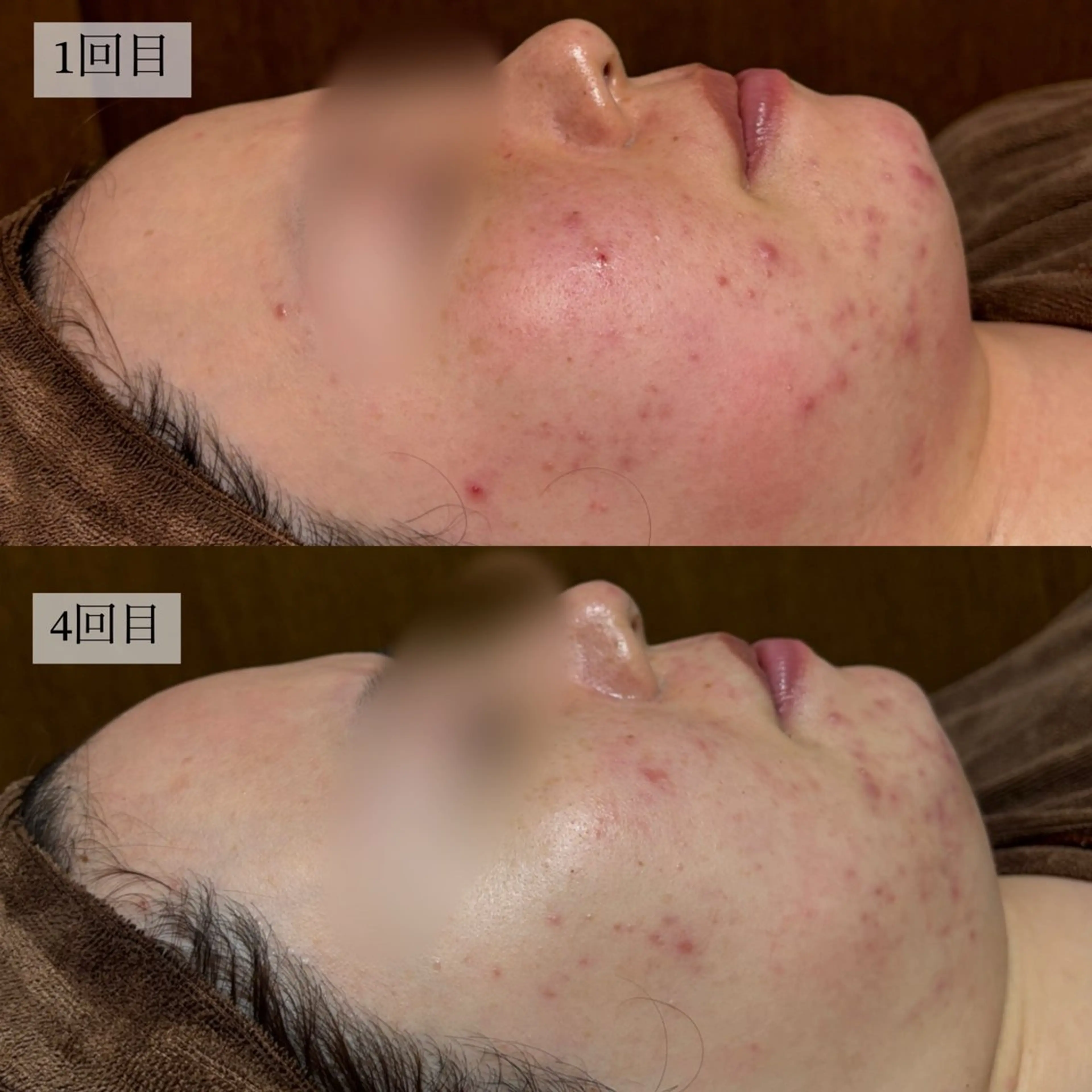 HINANO矢場町店【ヒナノ】所属・脱毛/肌改善🌿 HINANO 村田のエステ・リラクイメージ