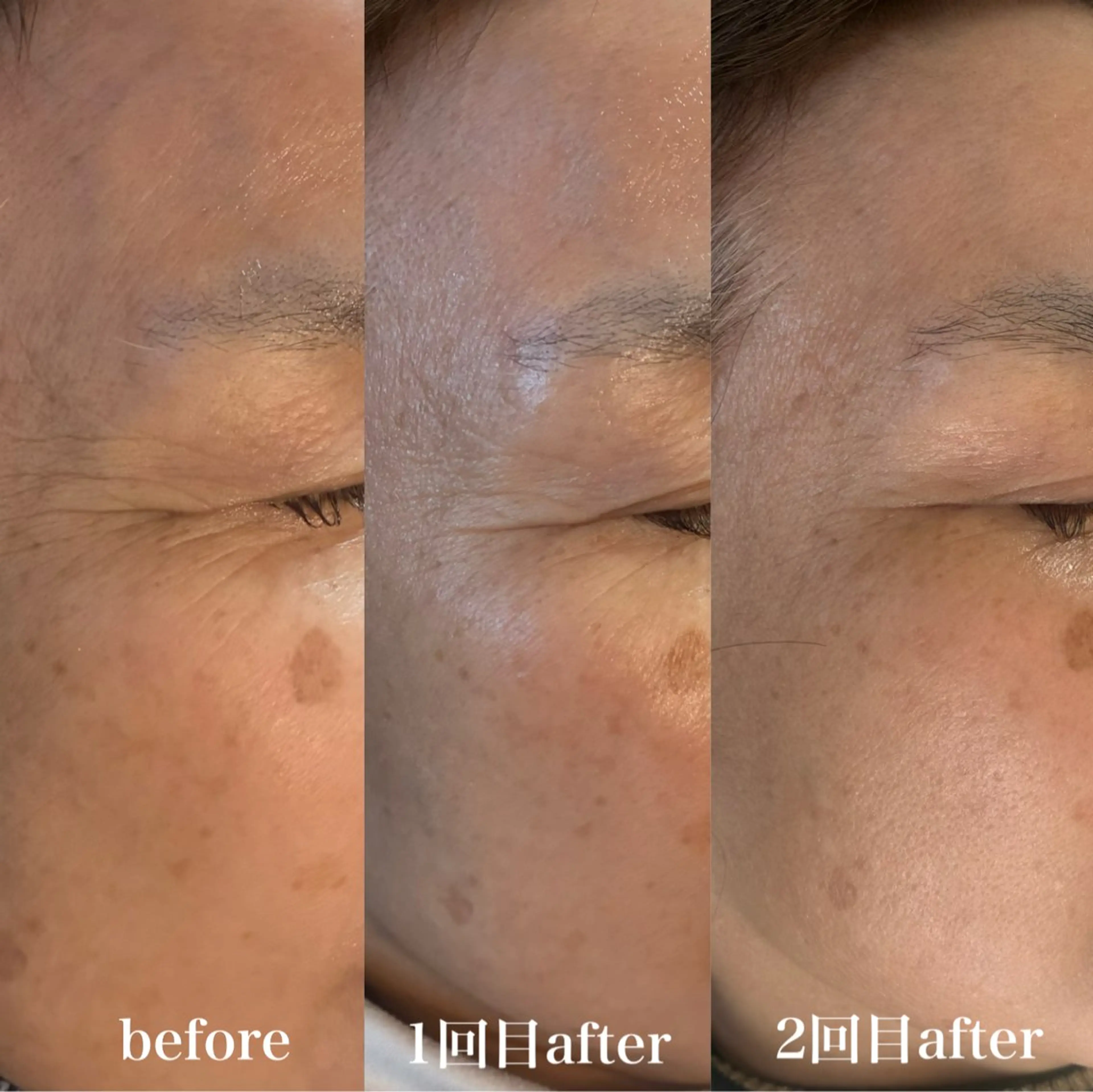 エステ フィユ所属・〚博多〛フィユ 水江のマツエク・マツパデザイン