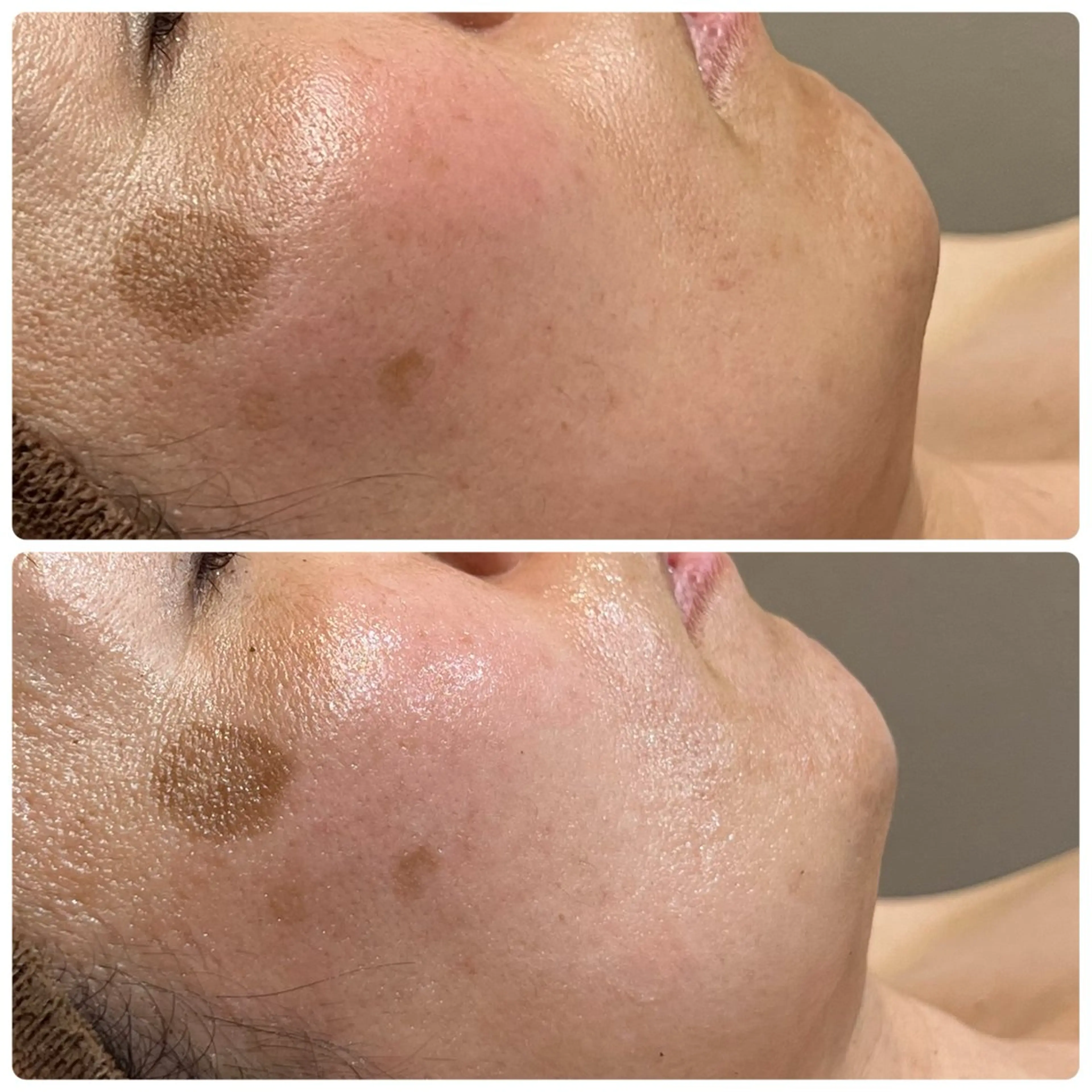 【REVI陶肌トリートメント】つるんと生まれ変わった肌への写真